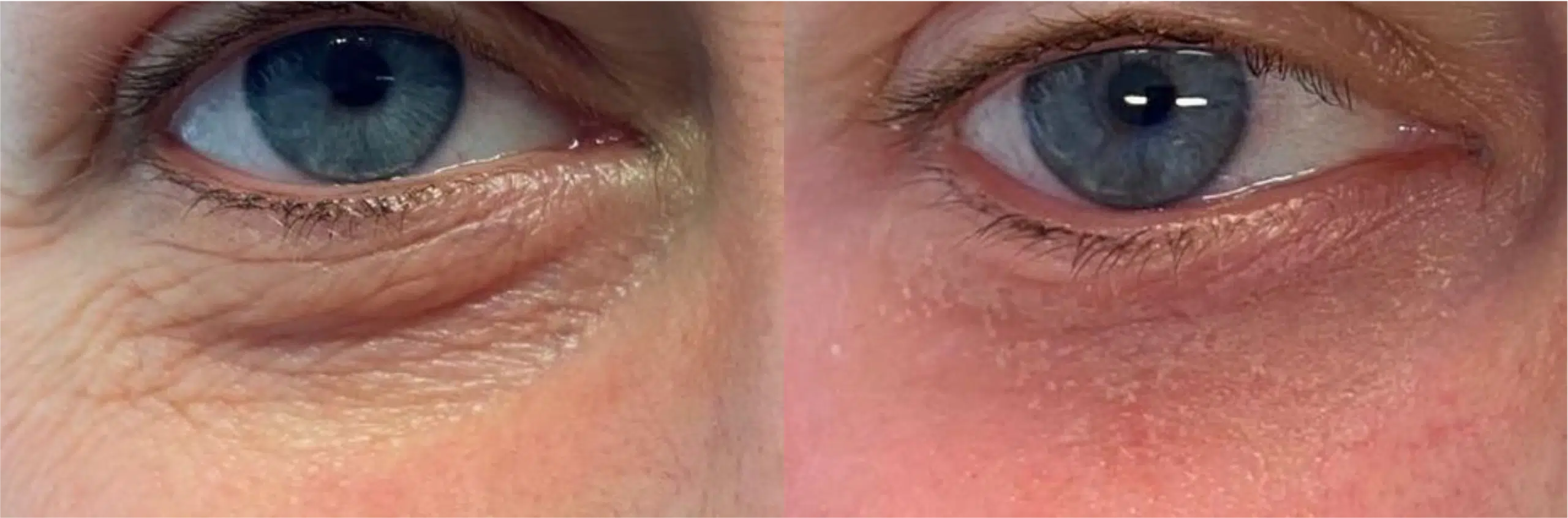 blepharoplastie lumenis ultrapulse alpha avant apres