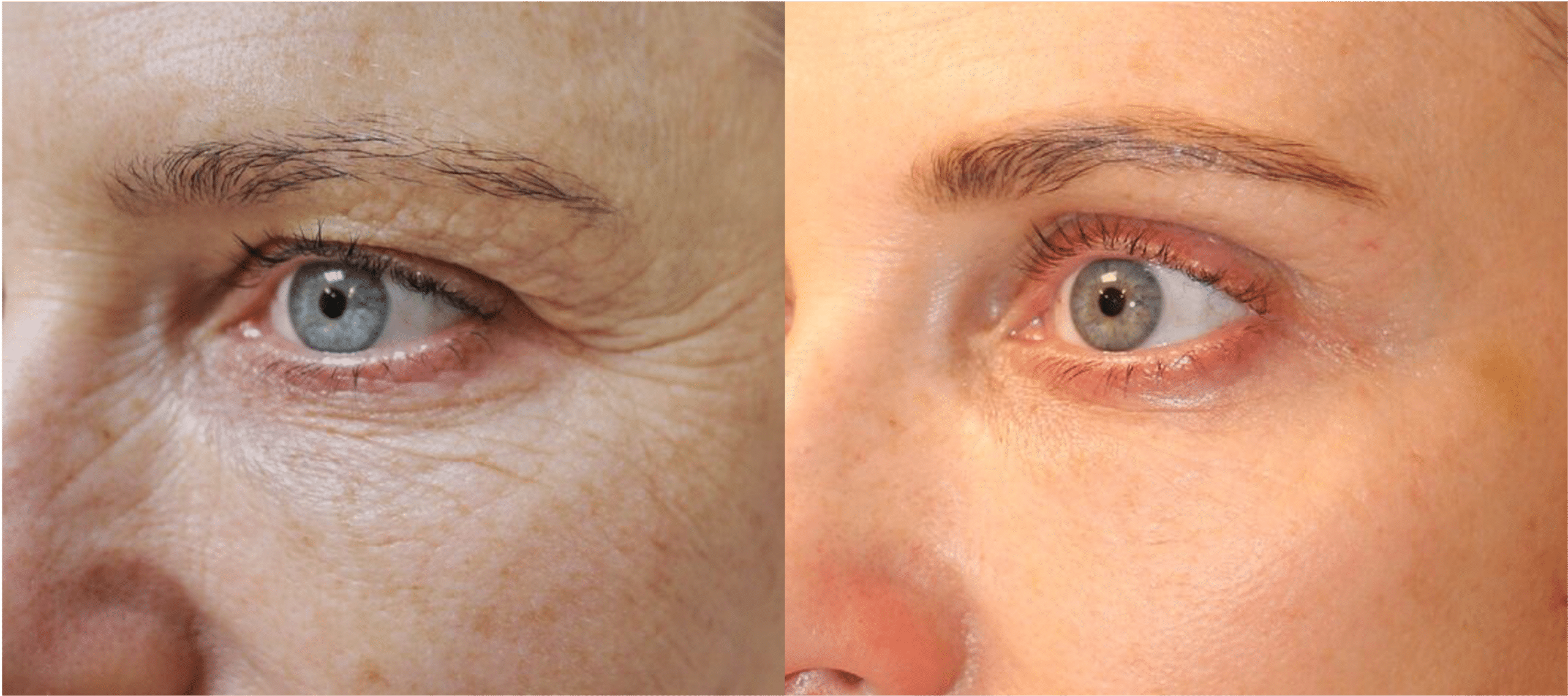 blepharoplastie lumenis ultrapulse alpha avant apres