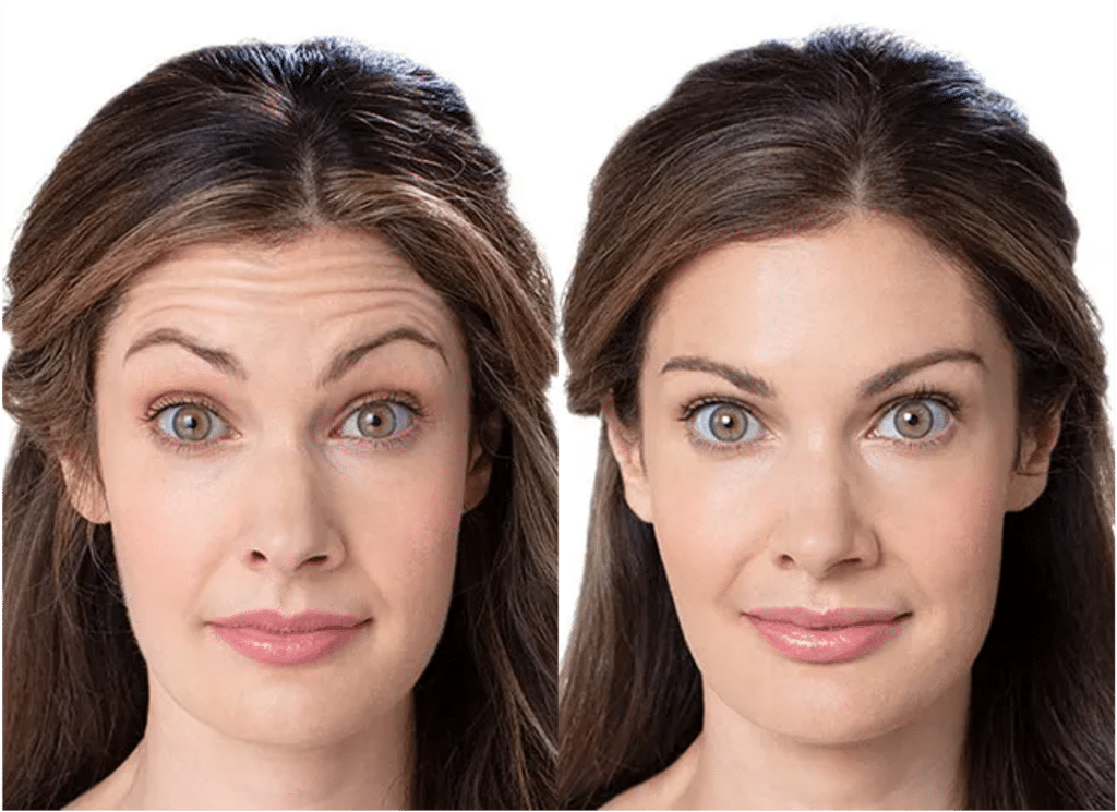Botox Visage Avant Après Dermatologue Skin Marceau