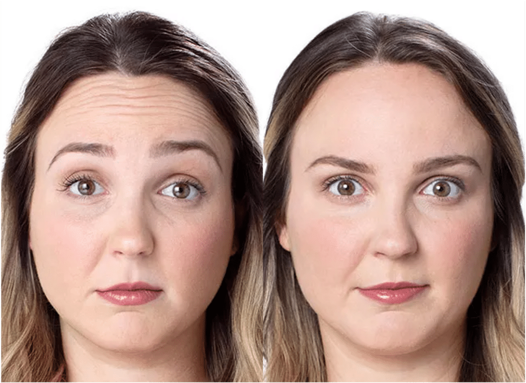 Botox Visage Avant Après Dermatologue Skin Marceau