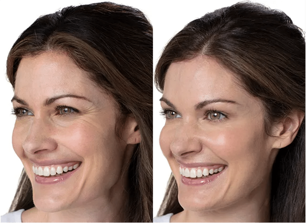 Botox Visage Avant Après Dermatologue Skin Marceau