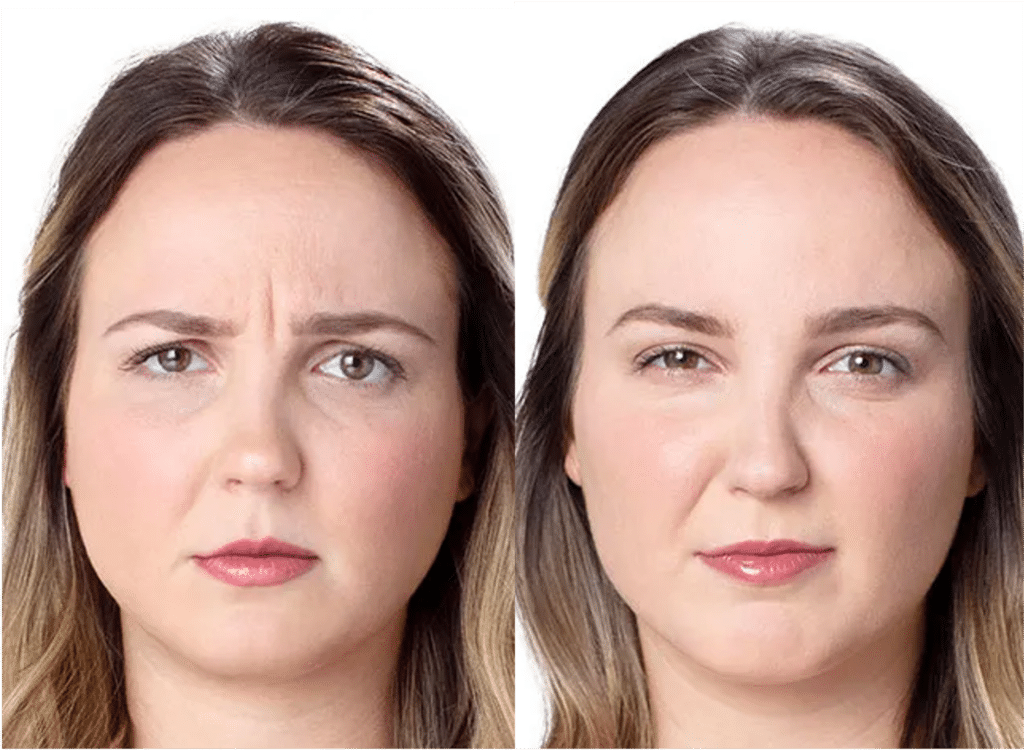 Botox Visage Avant Après Dermatologue Skin Marceau