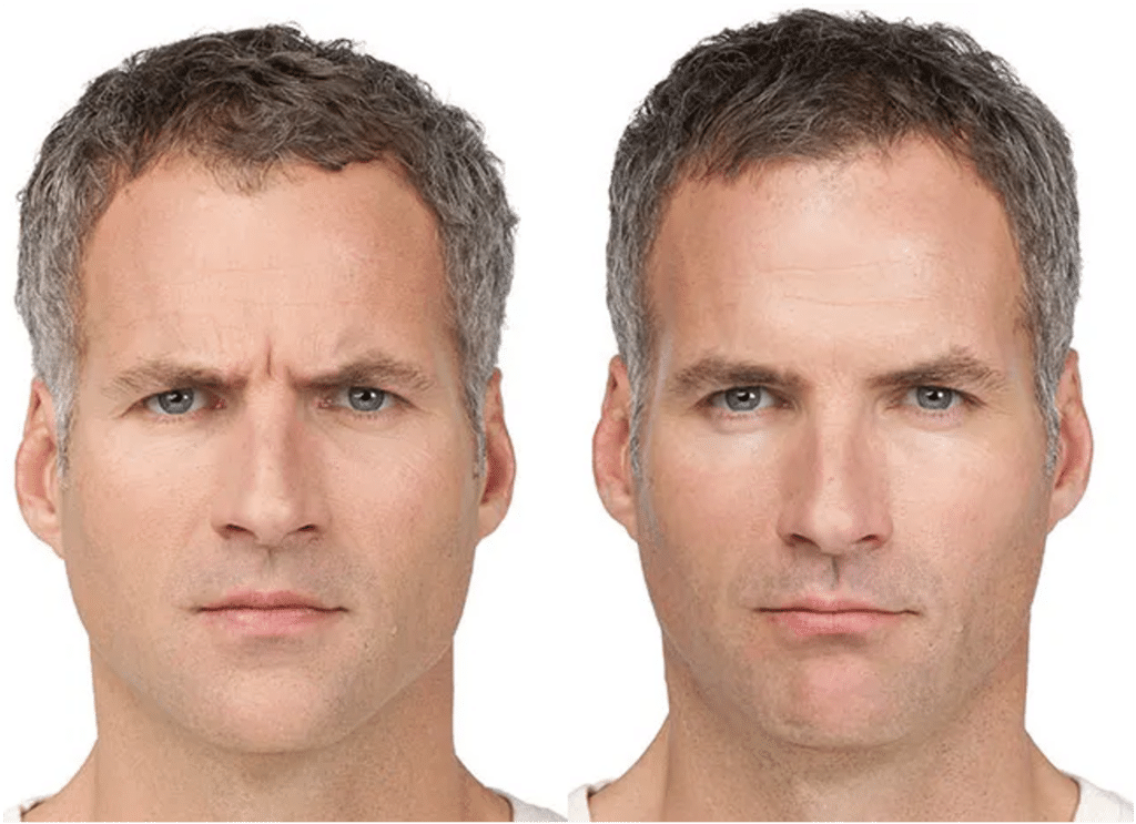 Botox Visage Avant Après Dermatologue Skin Marceau