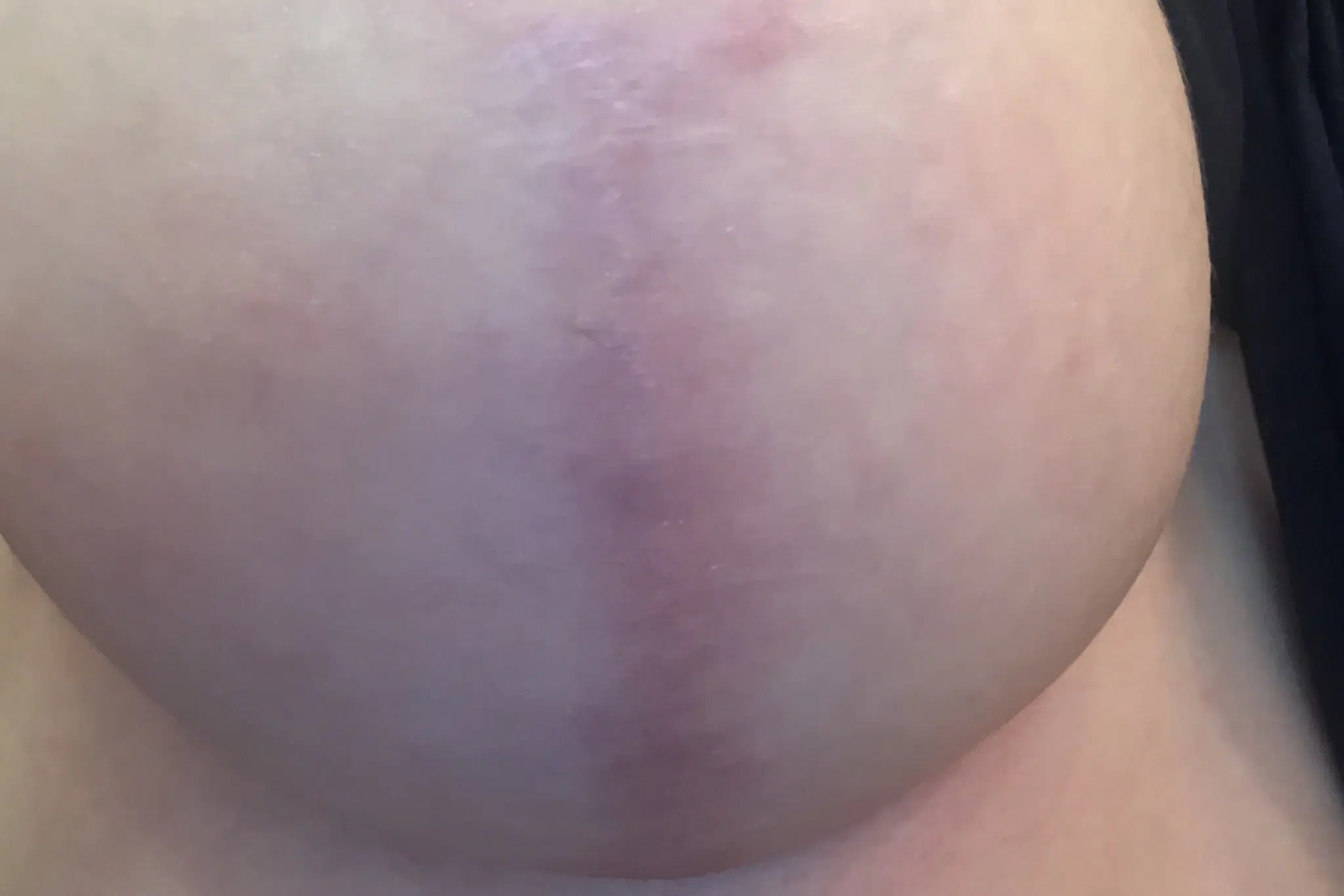 cicatrice reduction mammaire