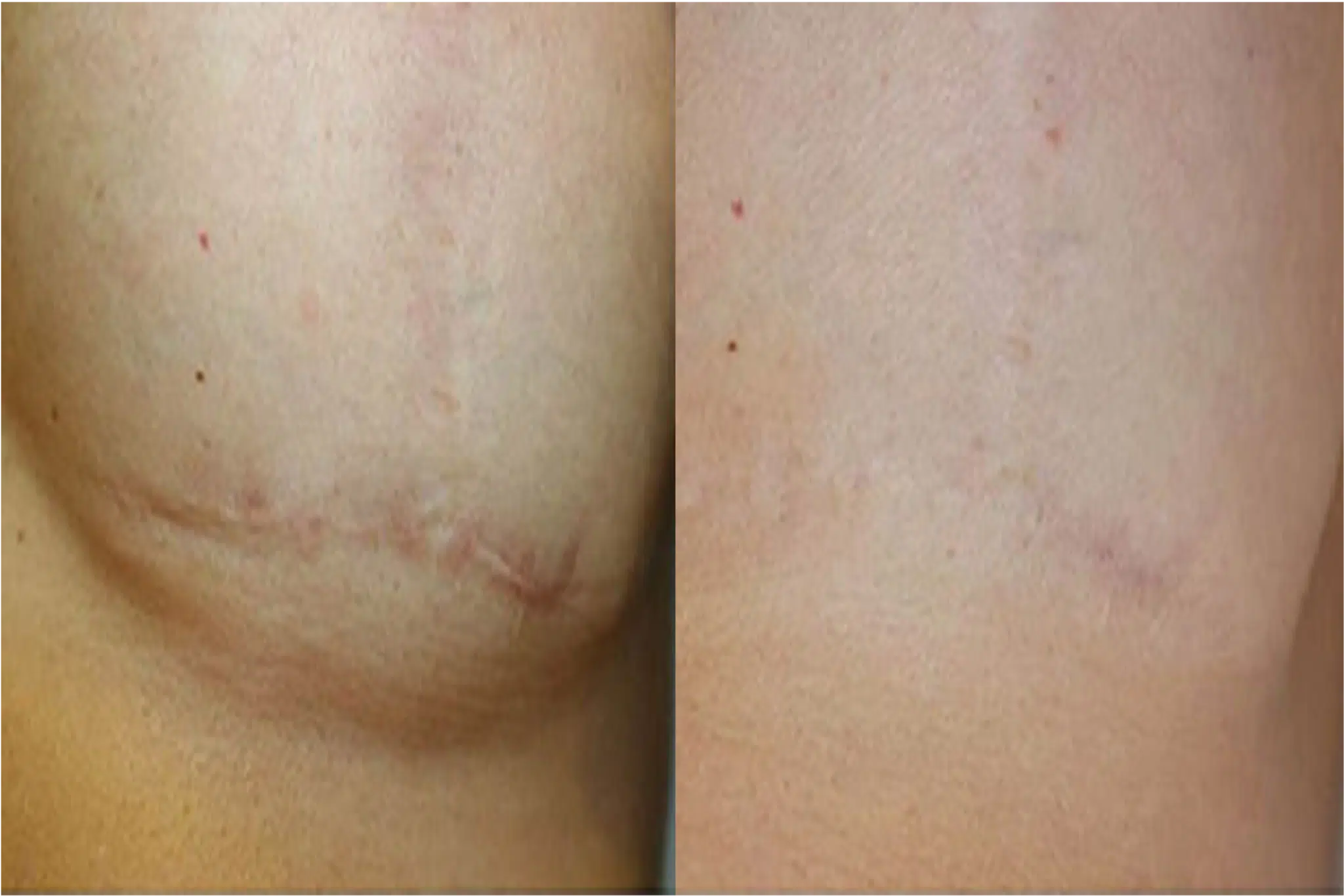 cicatrice reduction mammaire laser
