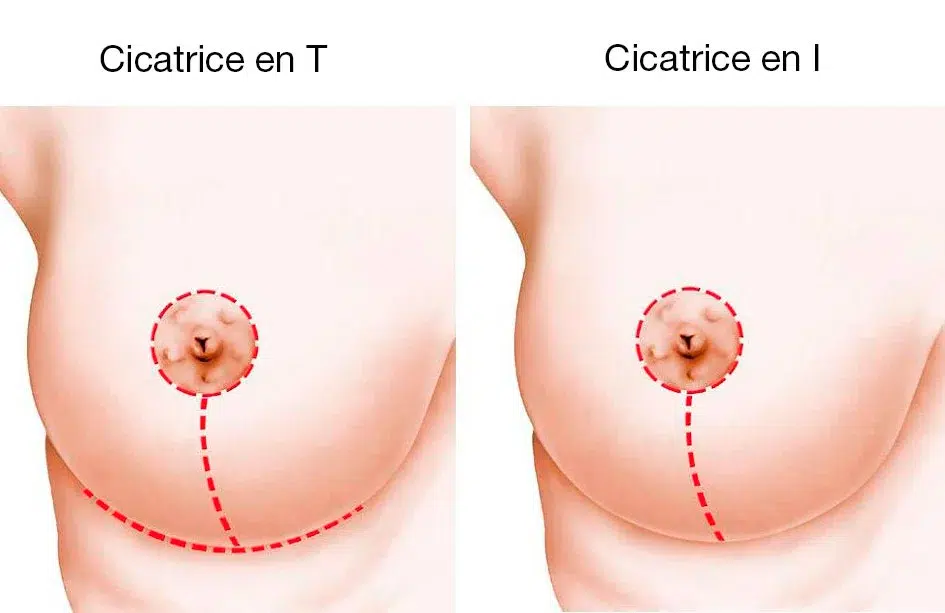 cicatrice lifting et reduction mammaire Skin Marceau Paris