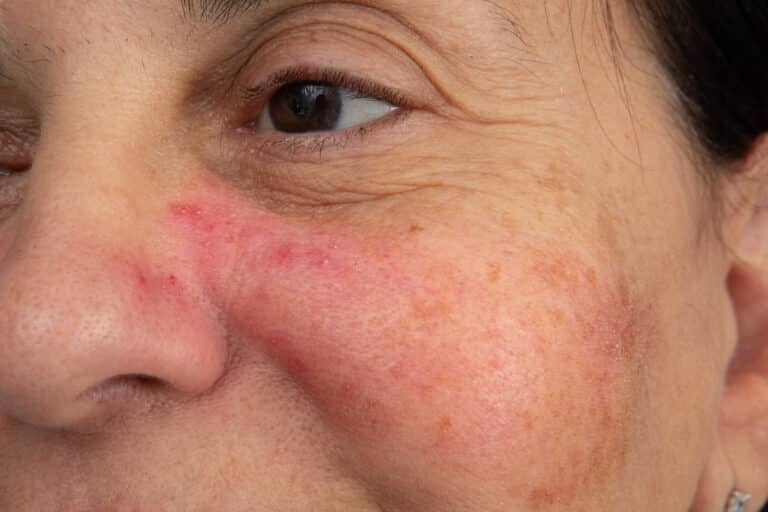 Photos Couperose / Rosacée sur le visage et le nez Skin Marceau
