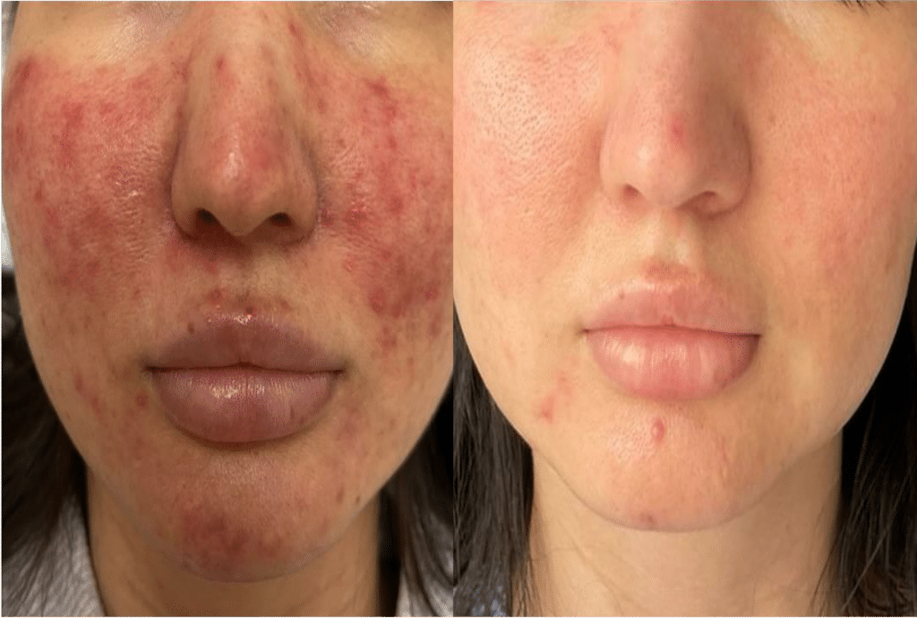 Laser Couperose Visage Résultats Avant et Après Skin Marceau