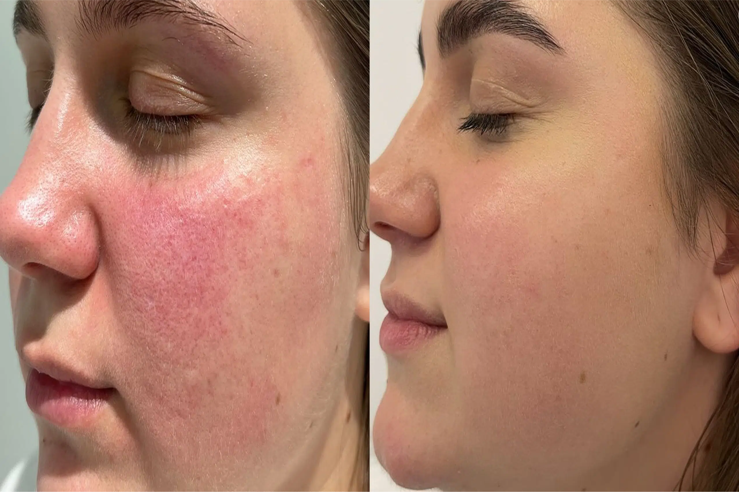 Couperose laser avant après