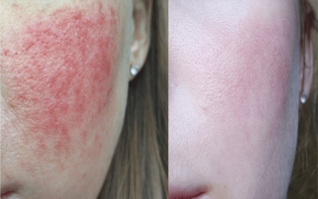 Laser Couperose Visage Résultats Avant et Après Skin Marceau