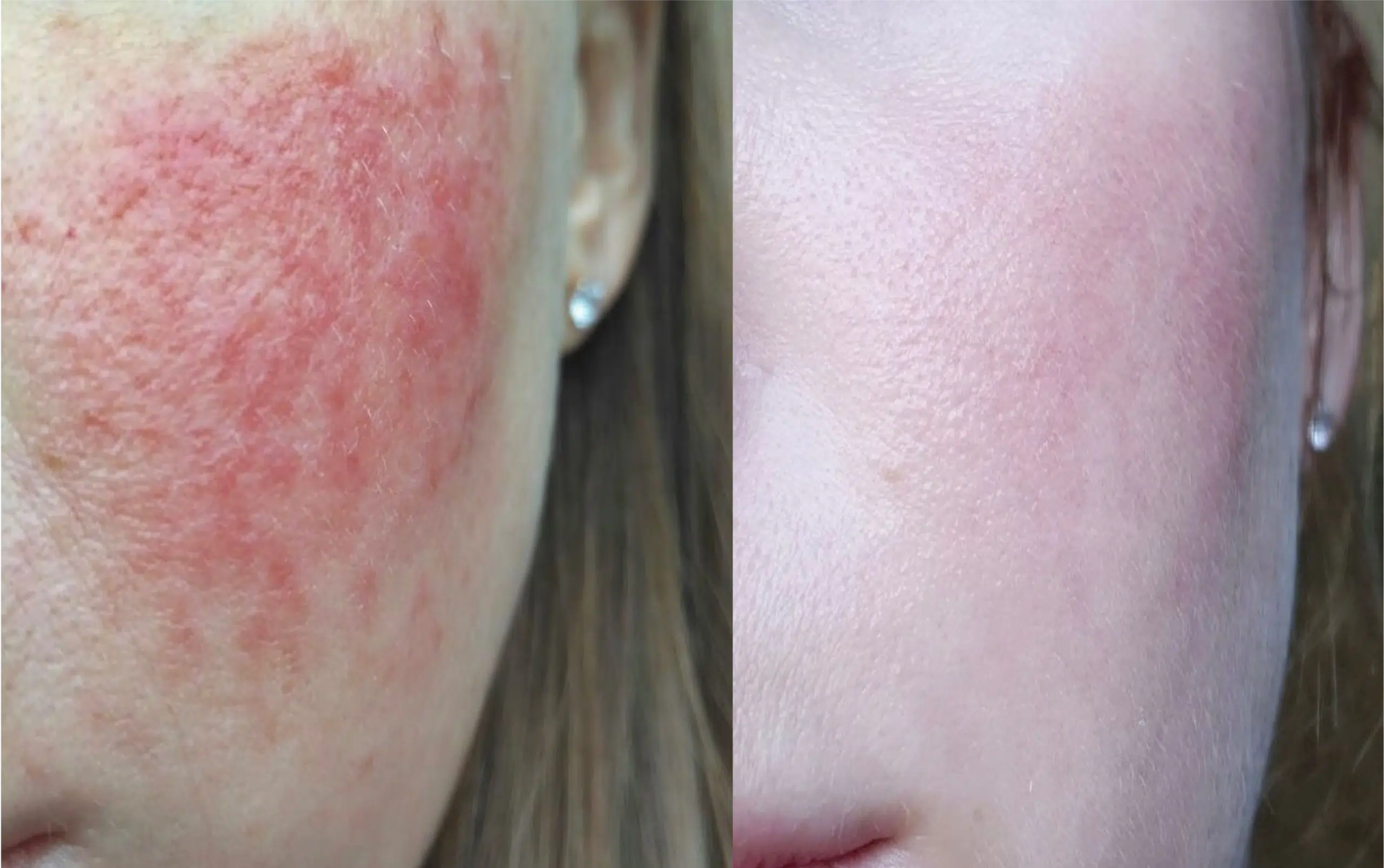 Couperose laser avant après