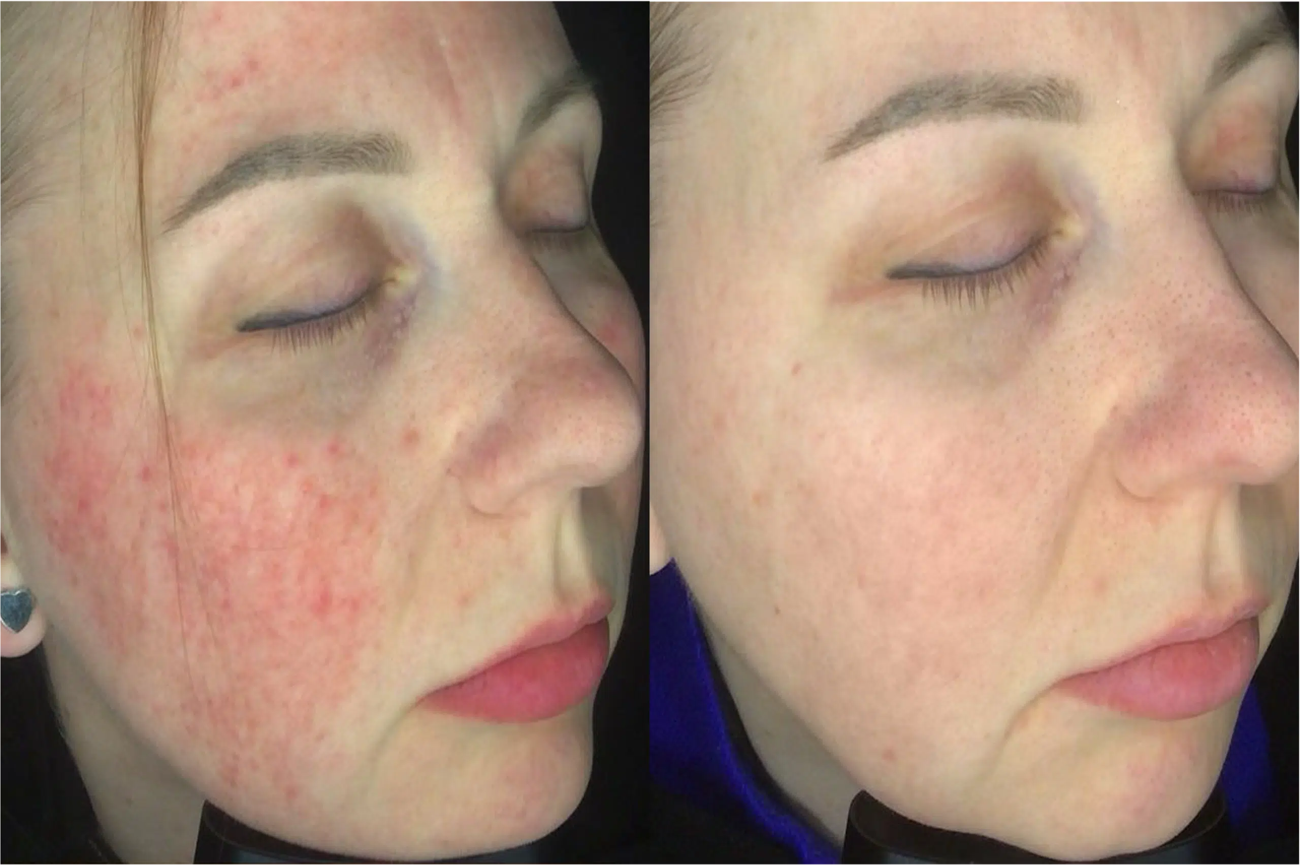 Couperose laser avant après