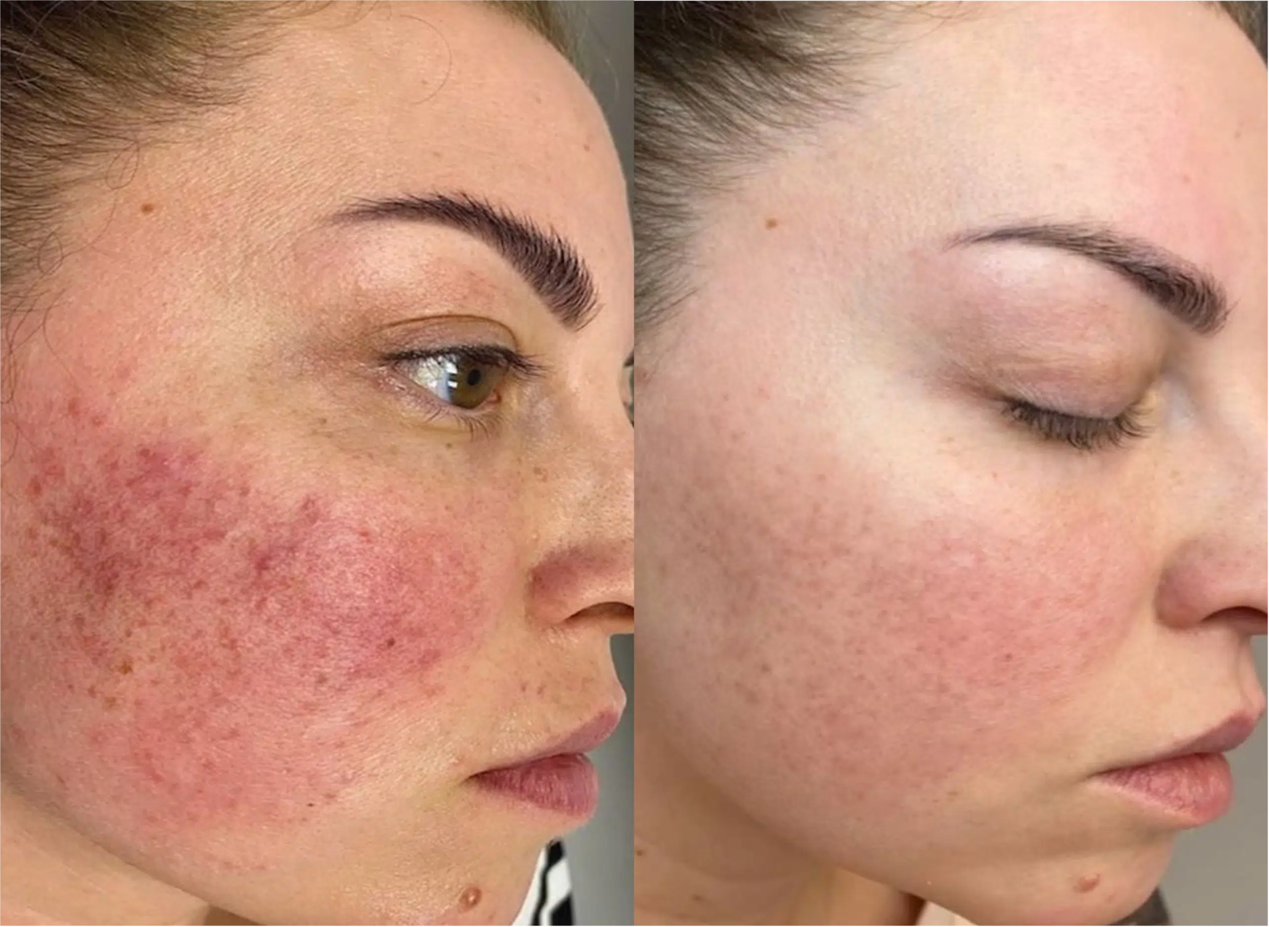 Couperose laser avant après