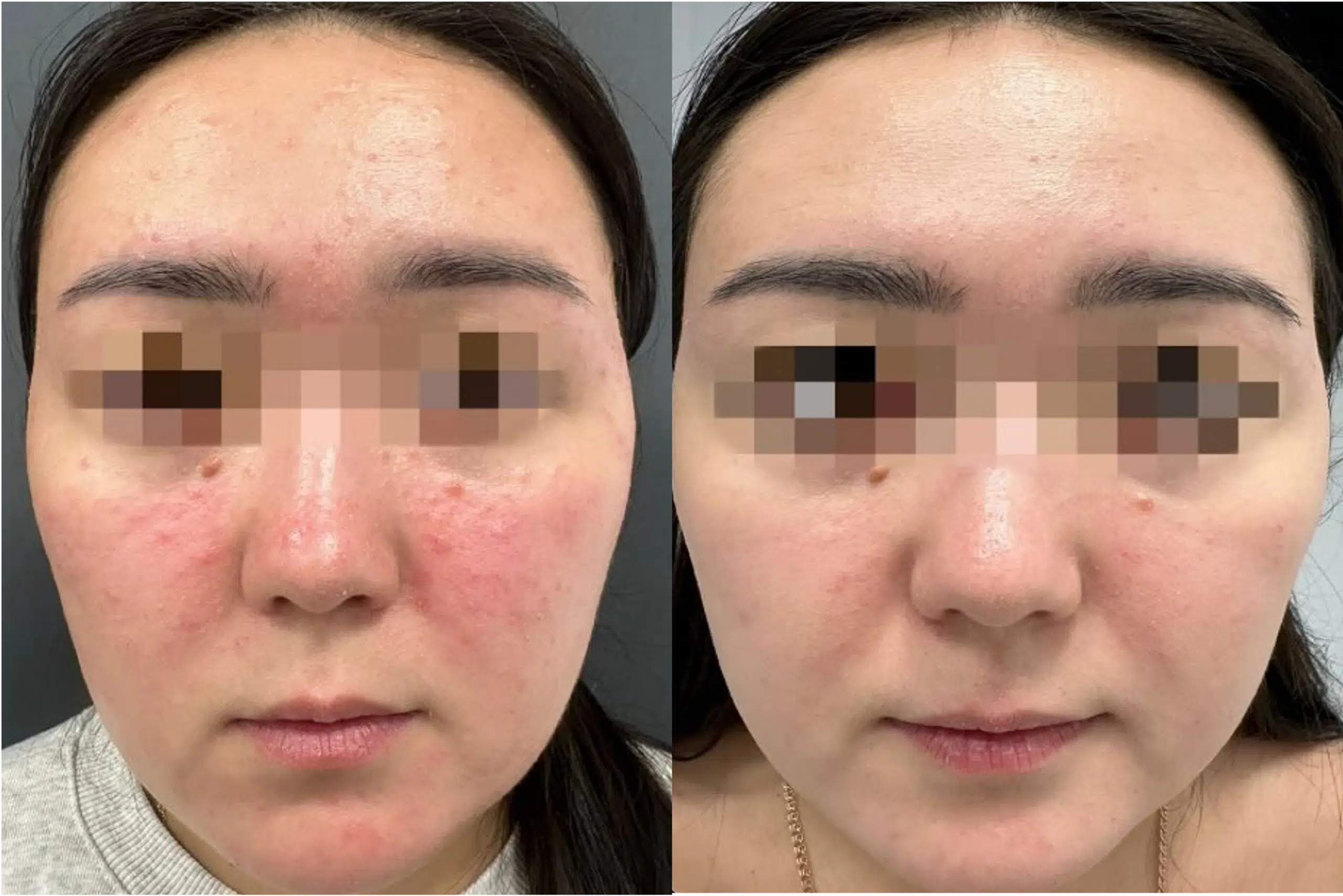 Couperose laser avant après