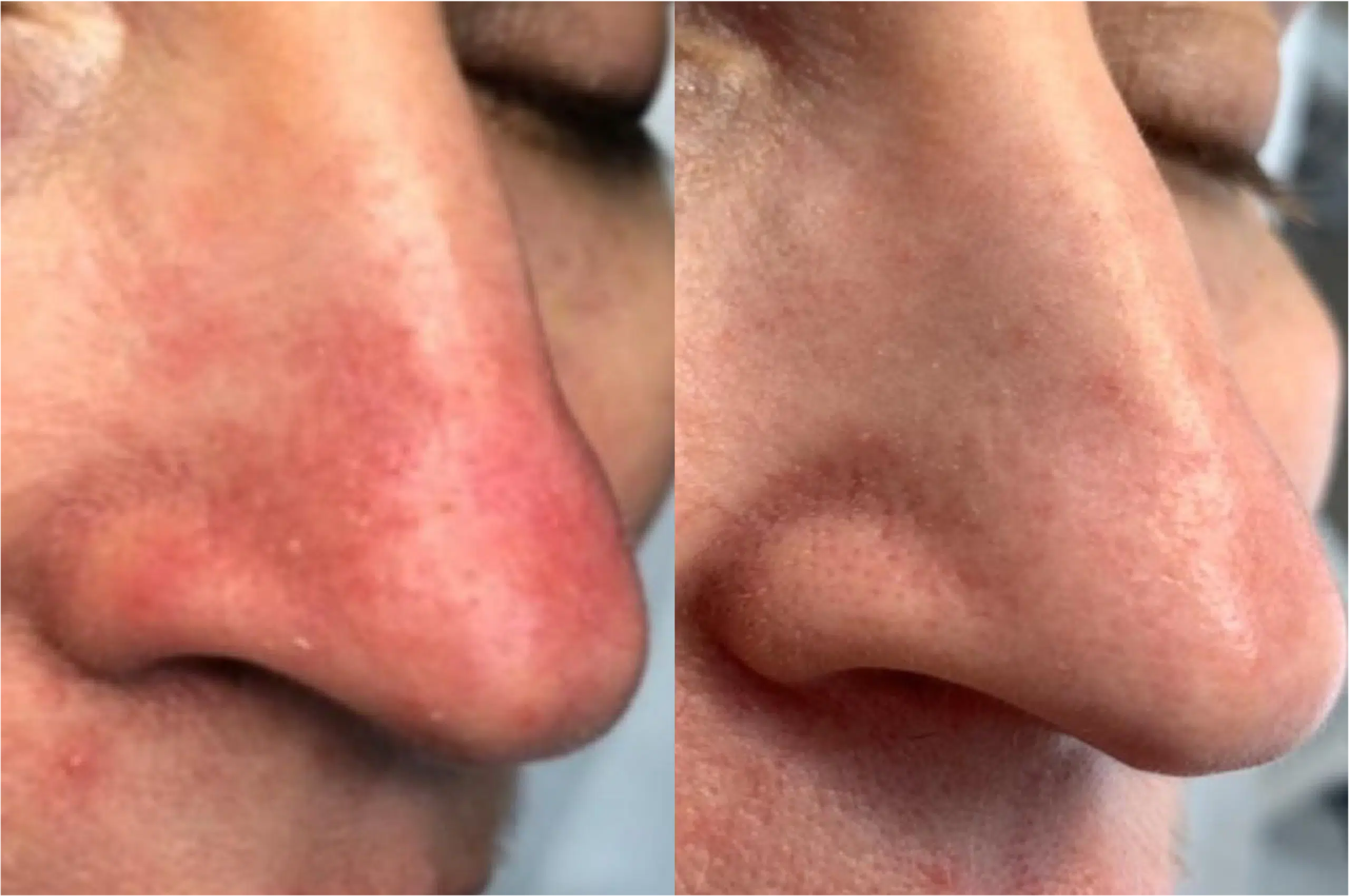 couperose nez laser avant apres