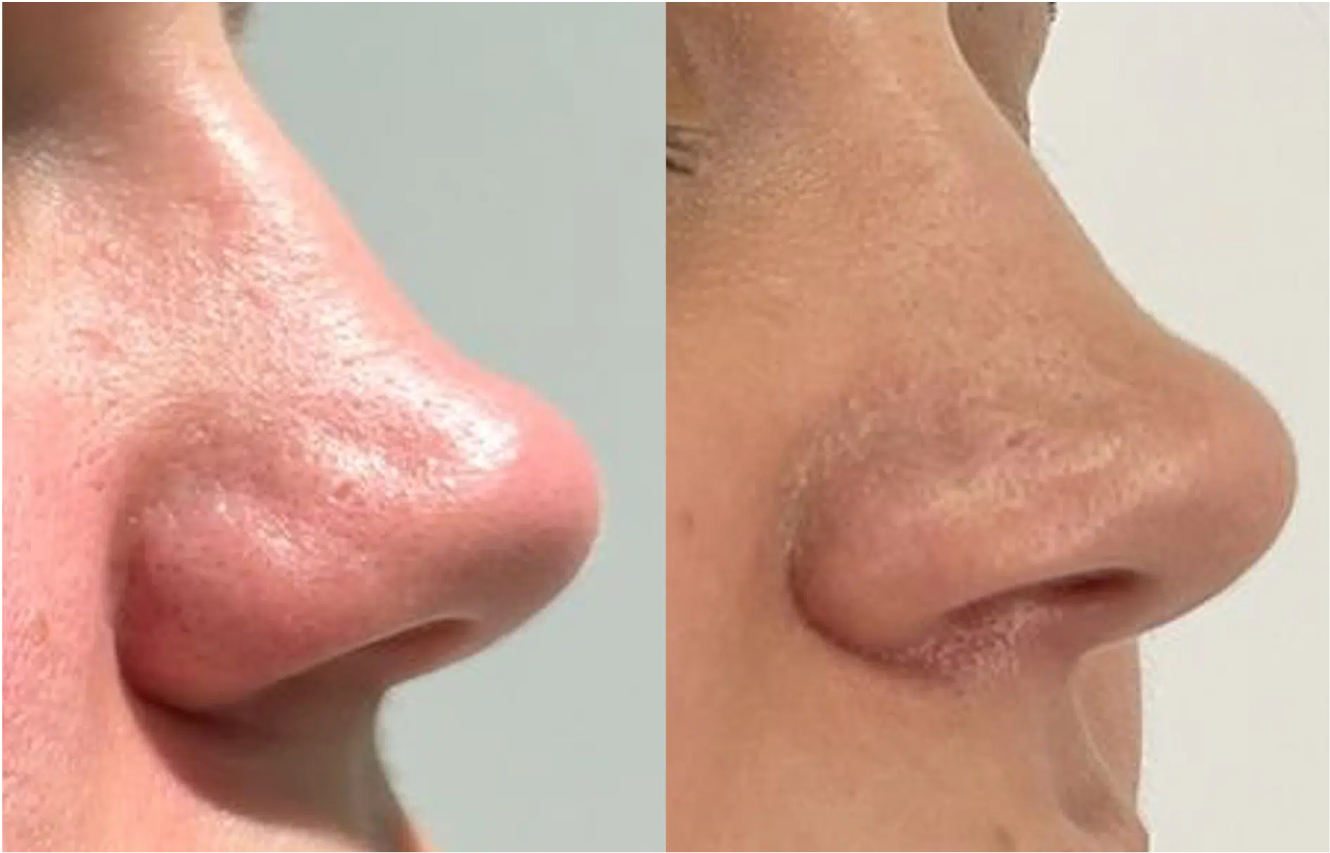 couperose nez laser avant apres