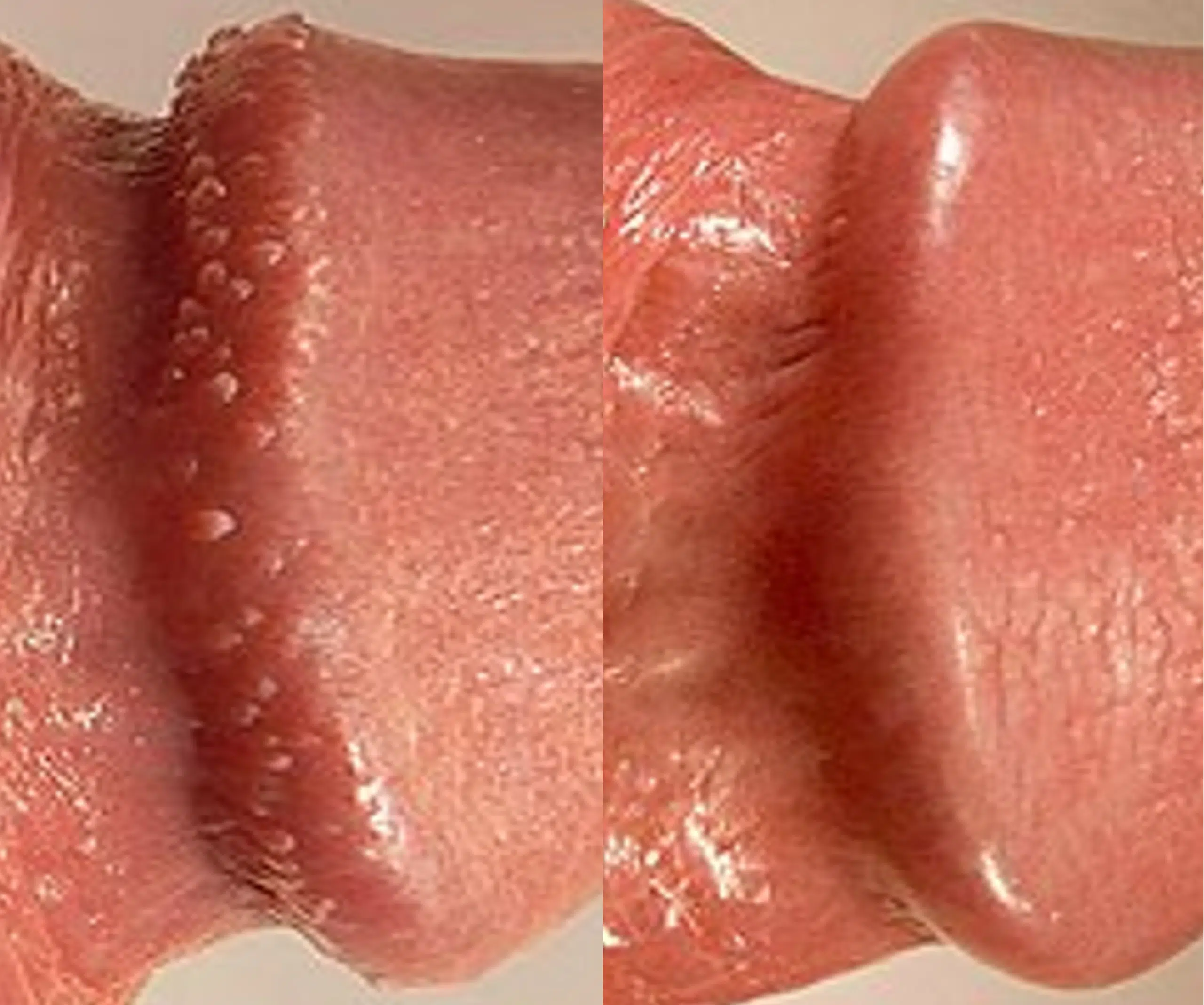 couronne perlèe du gland traitement avant apres