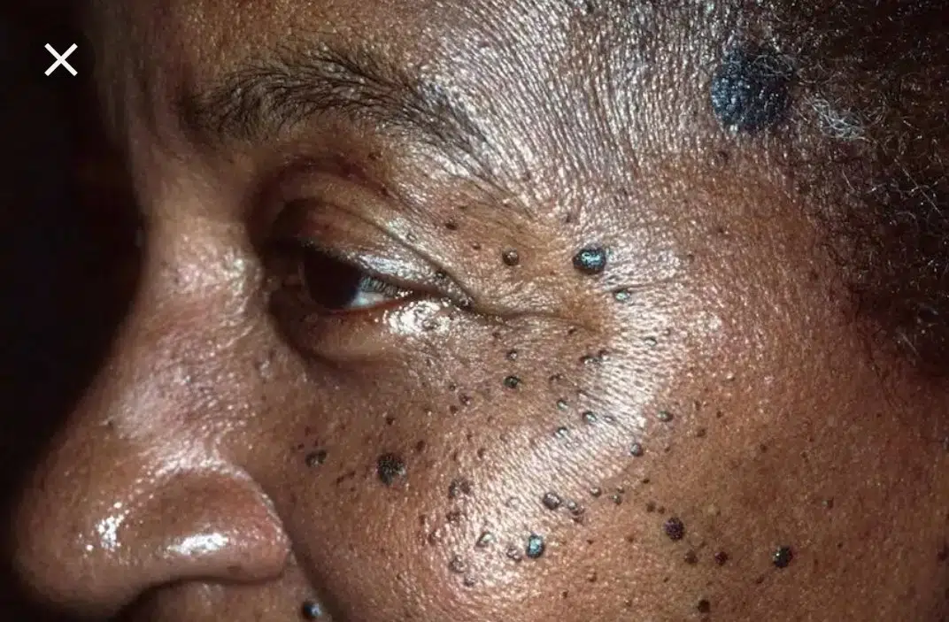 dermatosis papulosa nigra