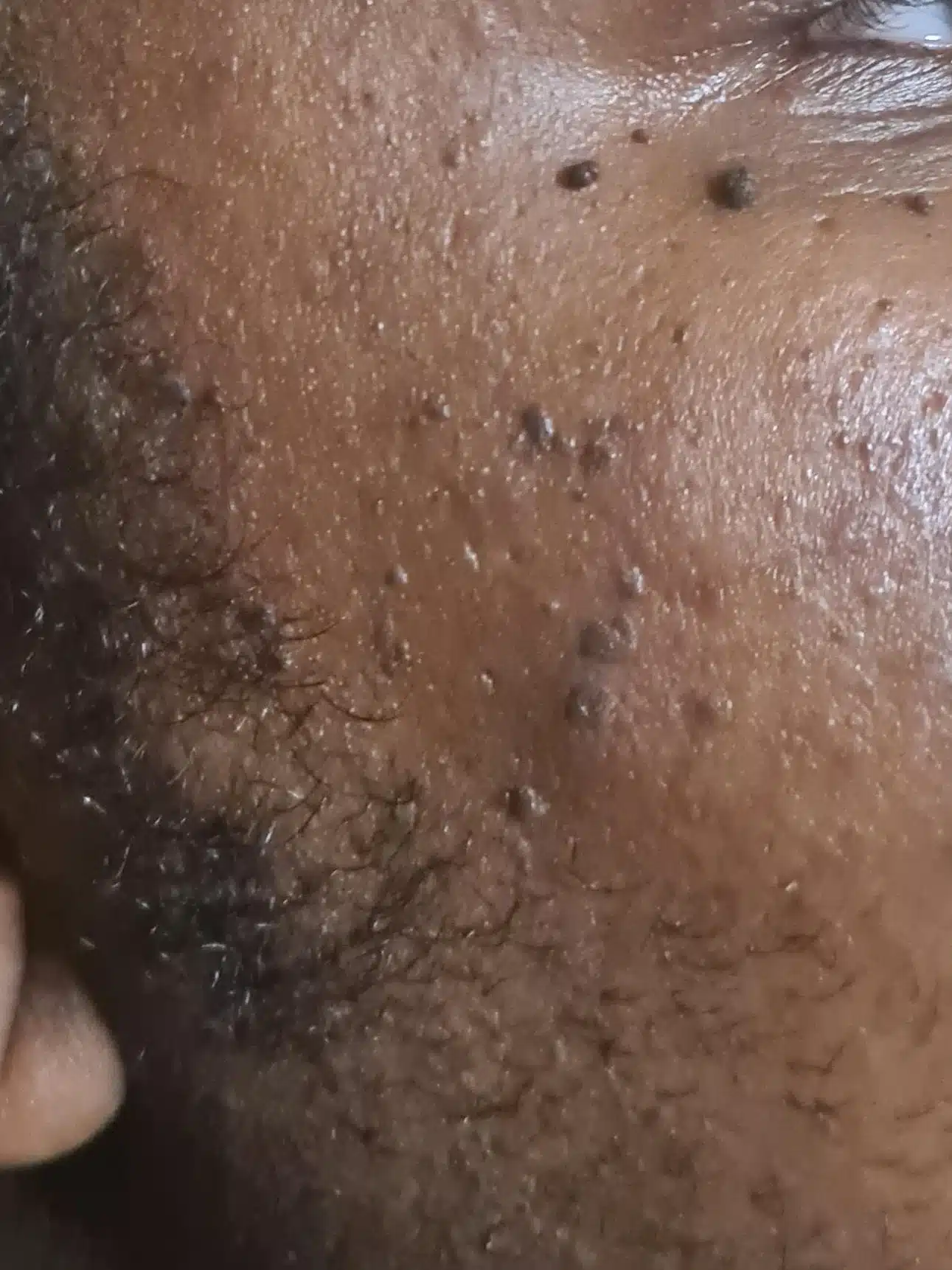 dermatosis papulosa nigra