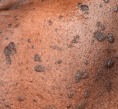 dermatosis papulosa nigra