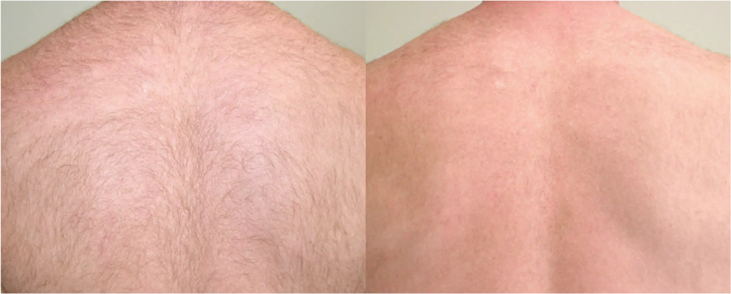 épilation laser dos avant apres Skin Marceau