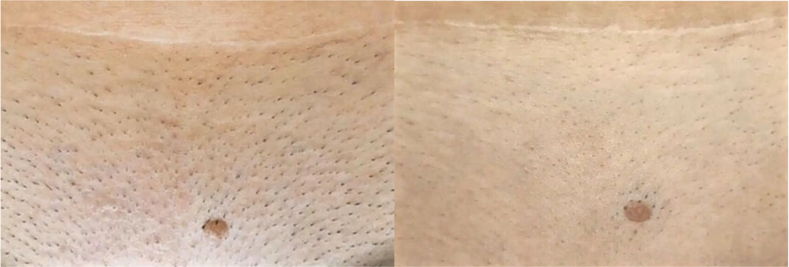 épilation intégrale du maillot avant après Skin Marceau laser Paris