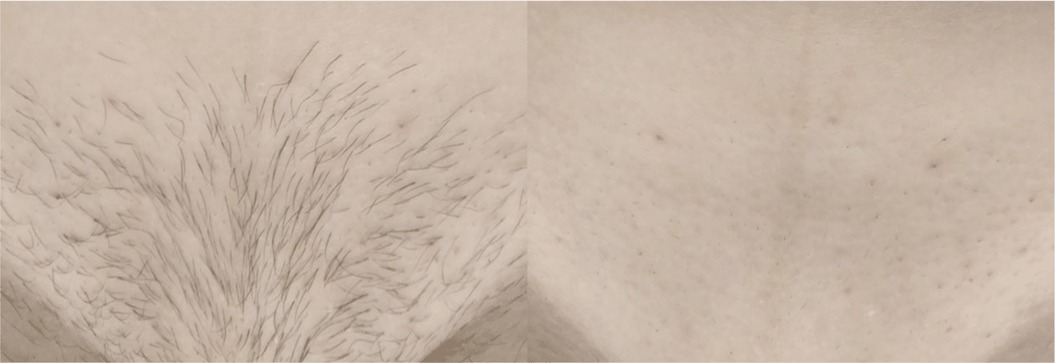 Tout savoir sur l’épilation du SIF (Sillon Interfessier)
