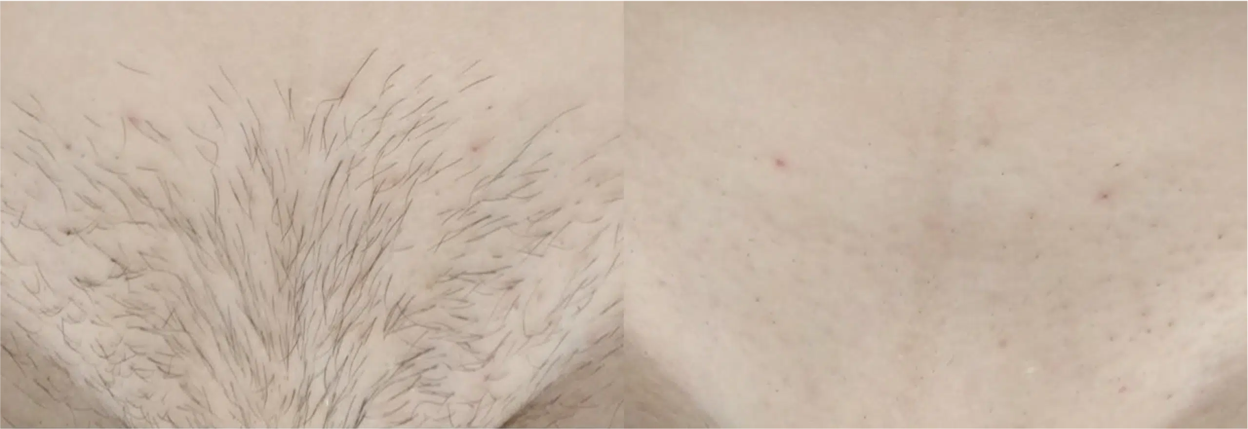 épilation intégrale du maillot avant après Skin Marceau laser Paris