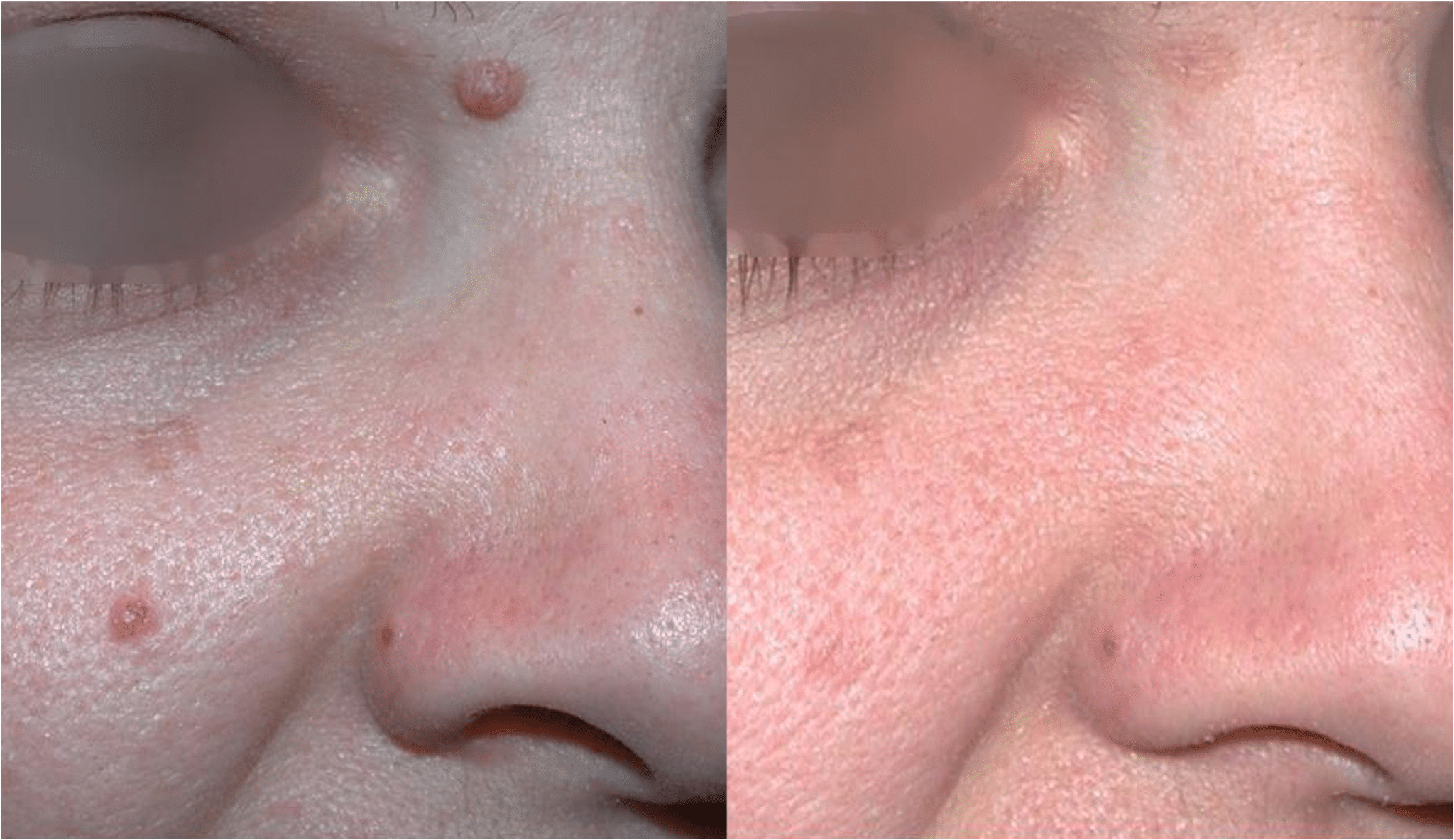 Laser CO2 Avant Après Dermatologue Esthétique Skin Marceau — free download