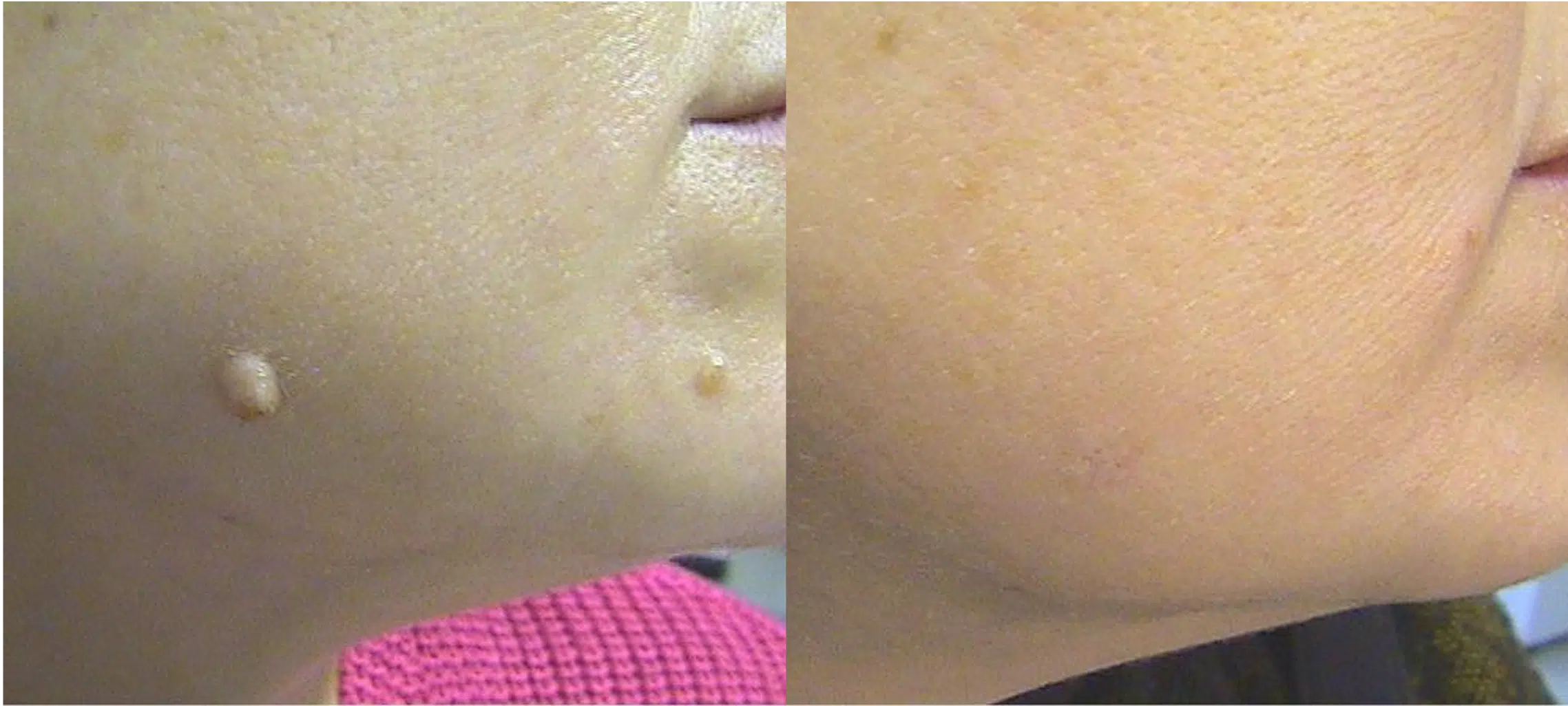 enlever grains des beauté visage laser avant après Skin Marceau Paris