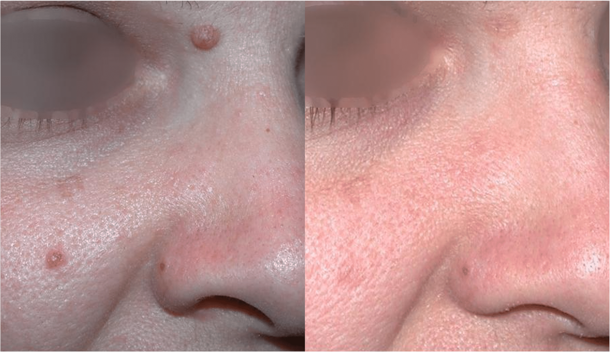 Enlever Les Grains De Beaut Au Laser Paris Dermatologue Esth tique Enlever Les Grains De Beaut Au Laser Paris Dermatologue Esth tique