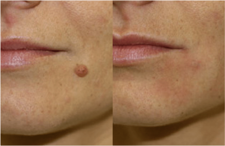 Prix Pour Enlever Un Grain De Beaut Dermatologue Esth tique Prix Pour Enlever Un Grain De Beaut Dermatologue Esth tique