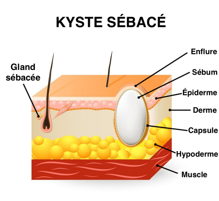 Kystes causes et traitements Clinique Skin Marceau Paris