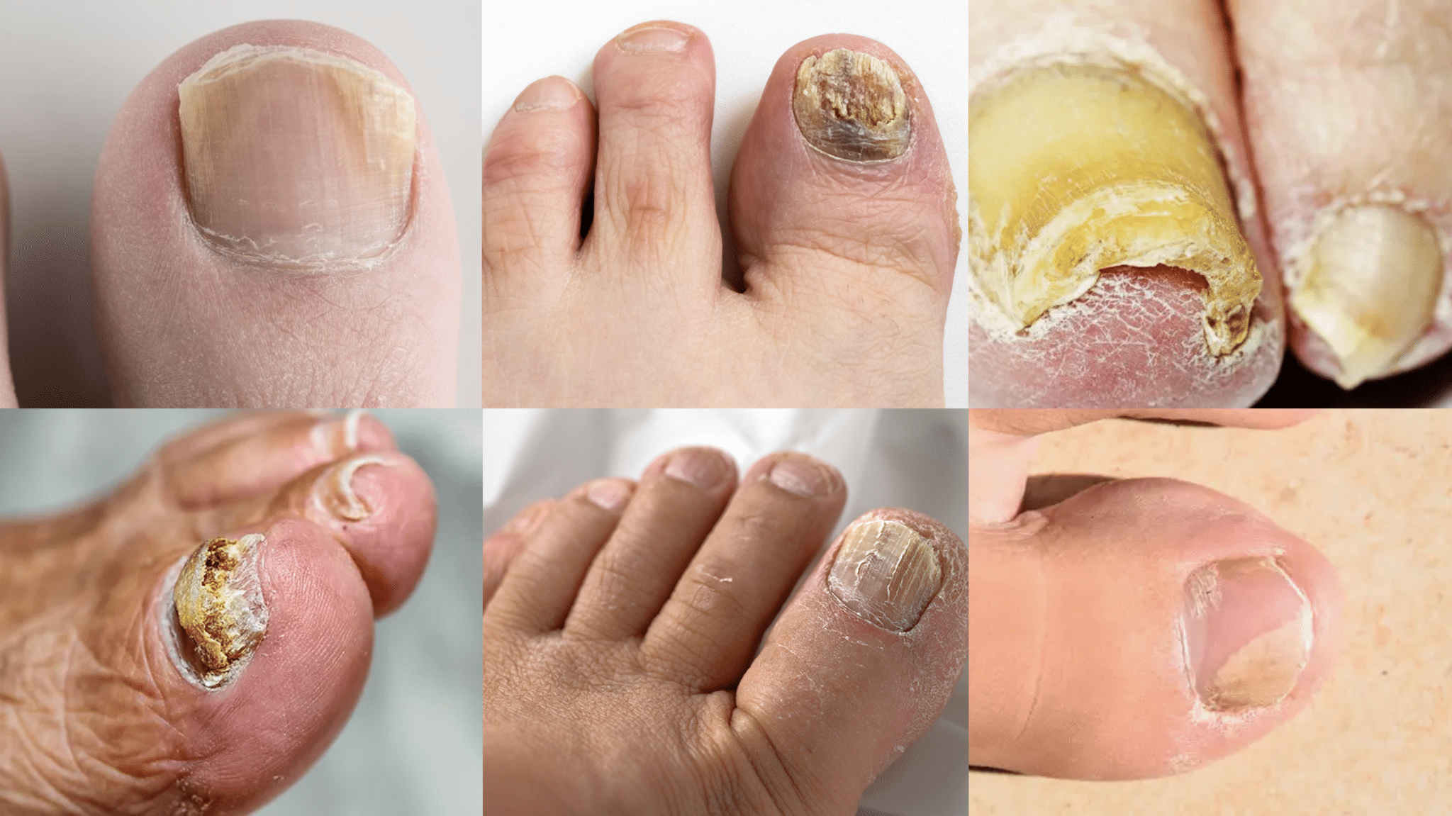 Mycoses des Ongles (pieds et mains) photos, traitements, symptômes et causes