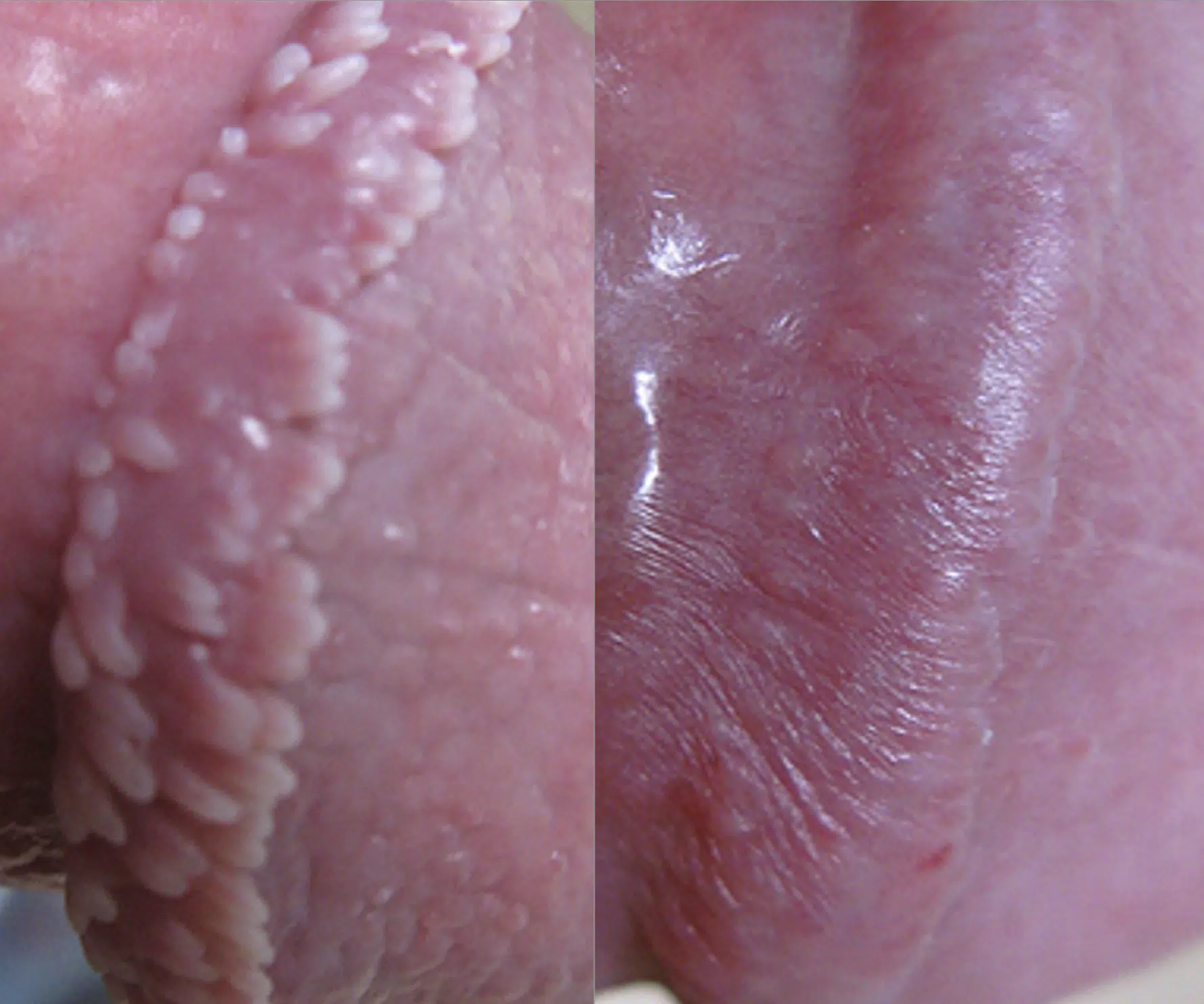 couronne perlèe du gland traitement avant apres