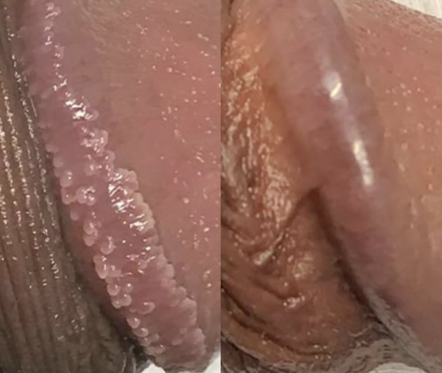 couronne perlèe du gland traitement avant apres