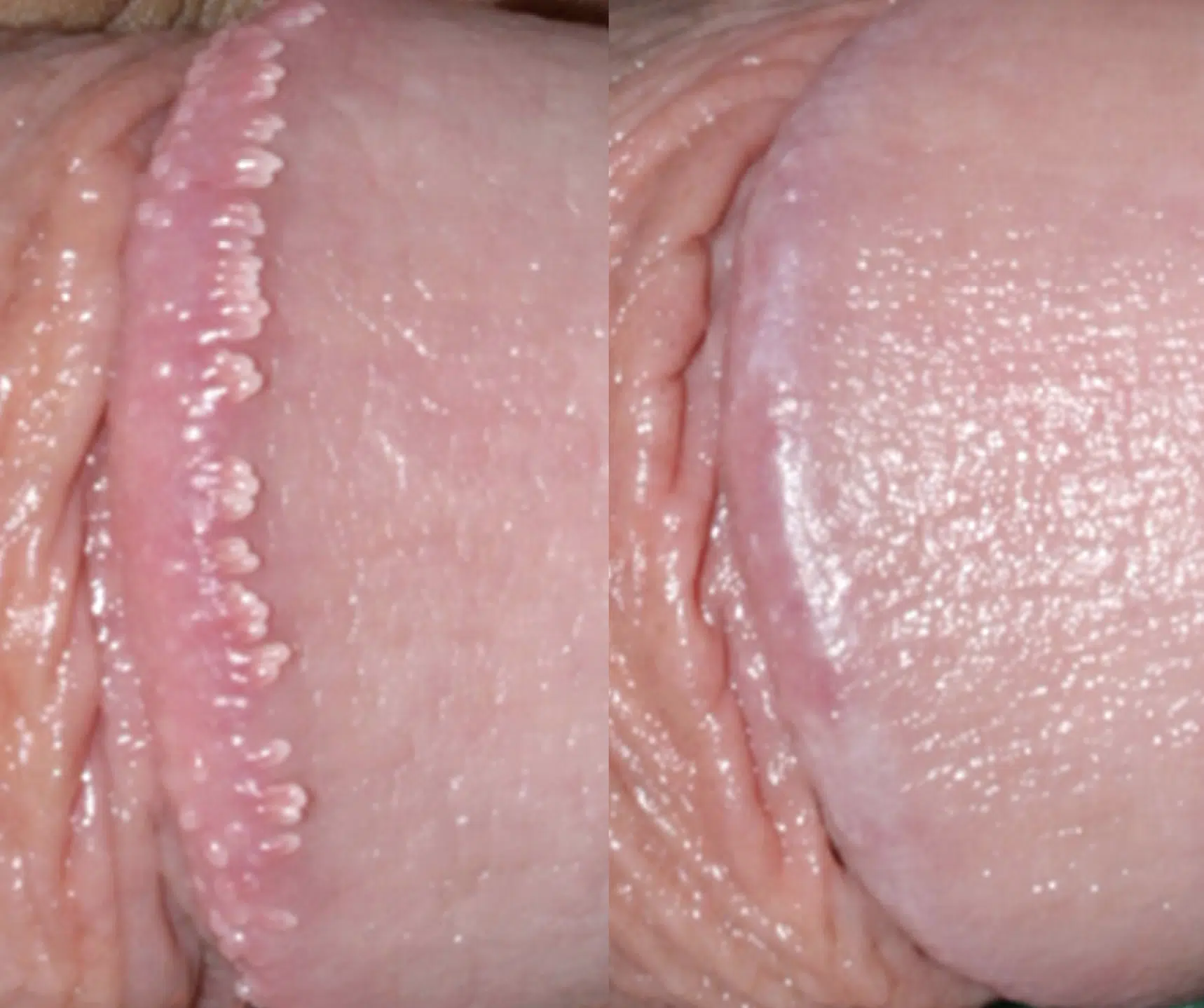 couronne perlèe du gland traitement avant apres