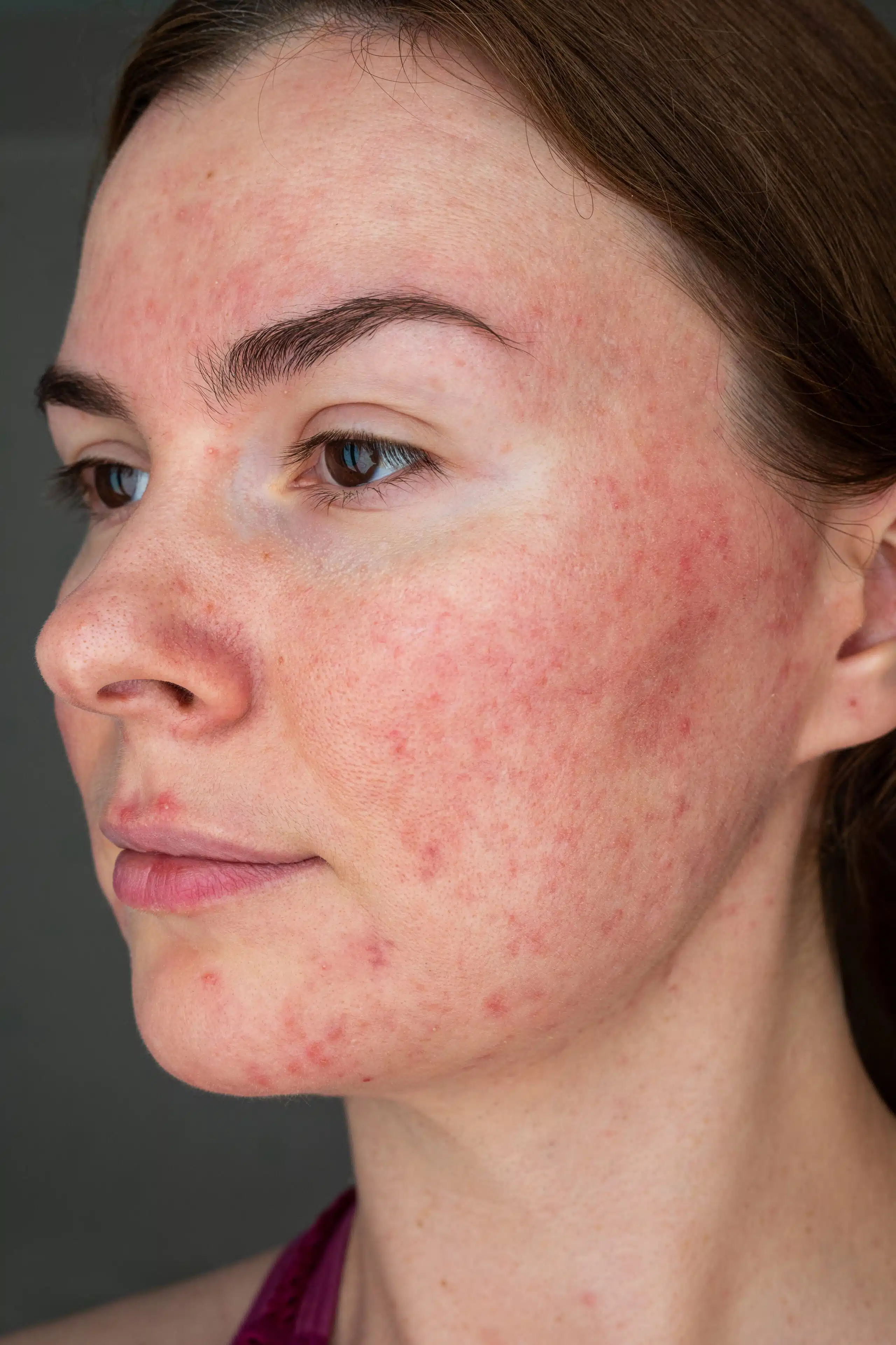 papulopustular rosacea