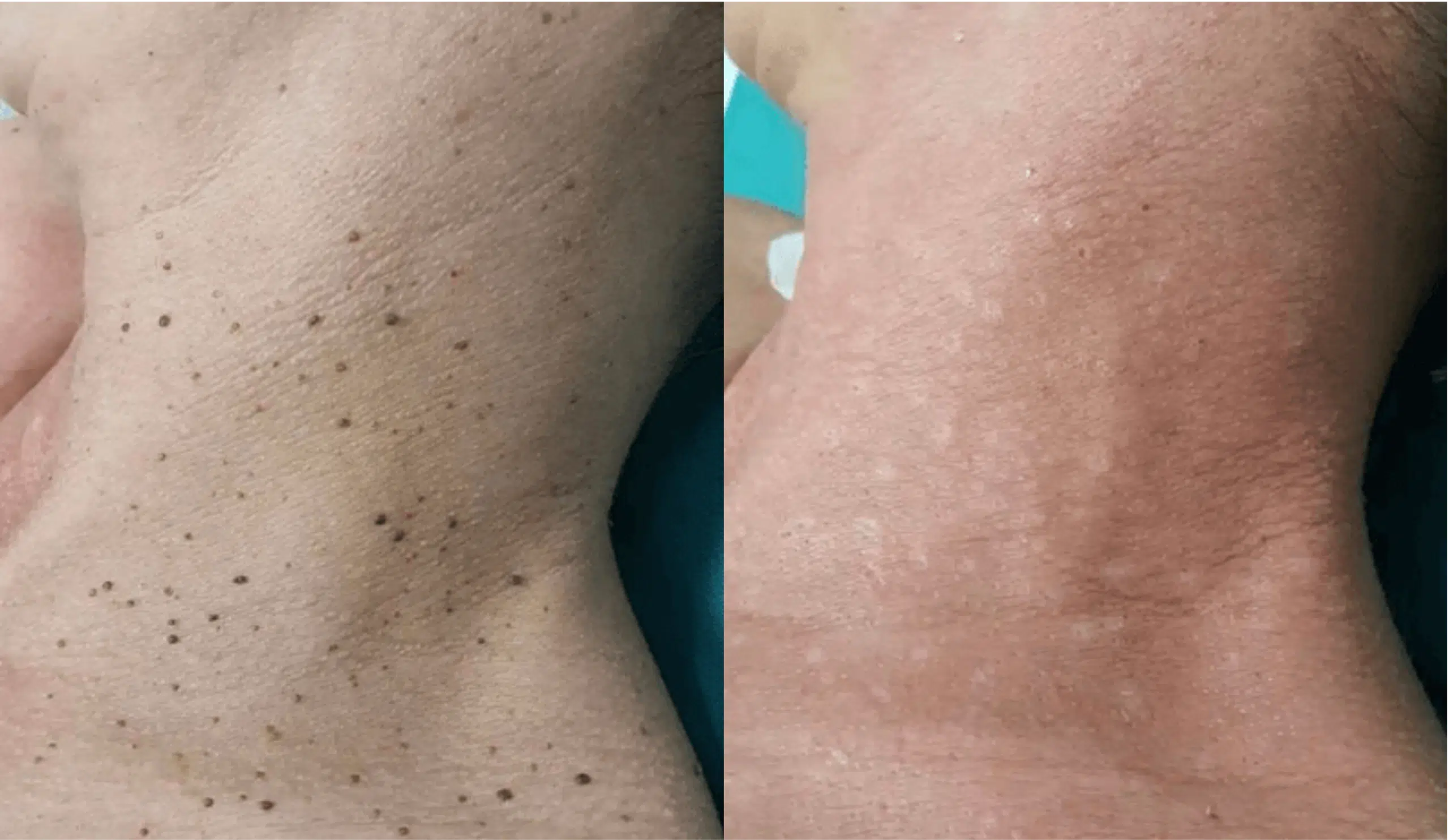 verrue molloscum pendulum cou avant apres laser