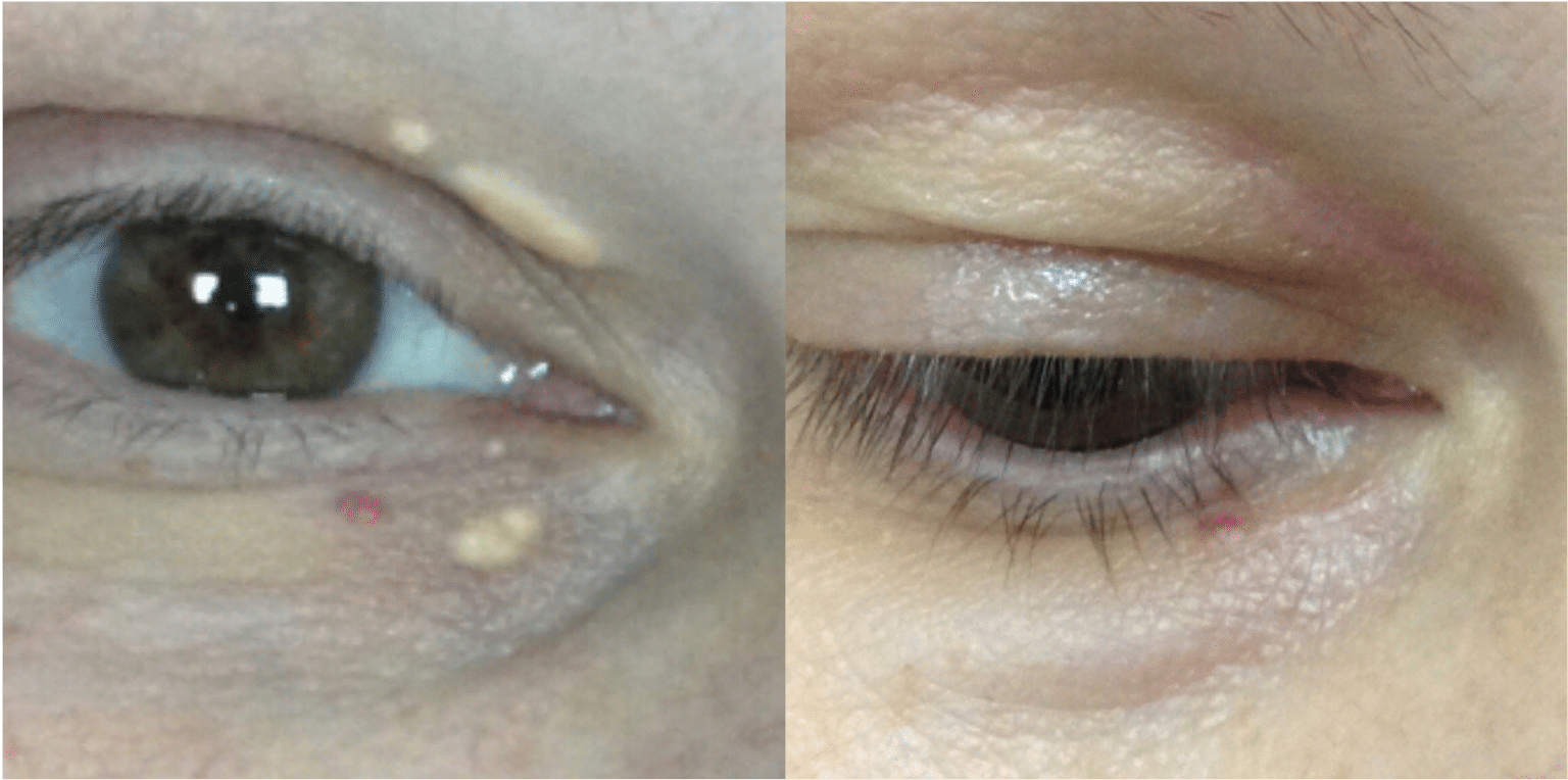 Laser CO2 Avant Après Dermatologue Esthétique Skin Marceau