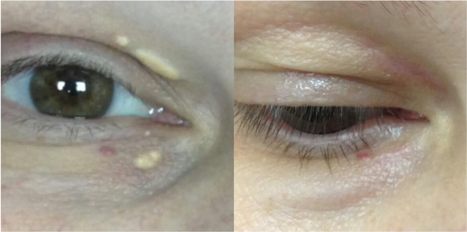 xanthélasma avant après traitement paupières jaunes Skin Marceau Paris