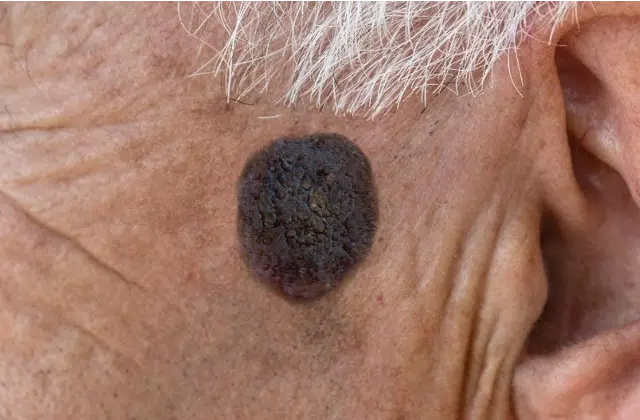 verrue seborrheique ou melanome