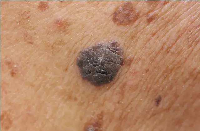 verrue seborrheique ou melanome
