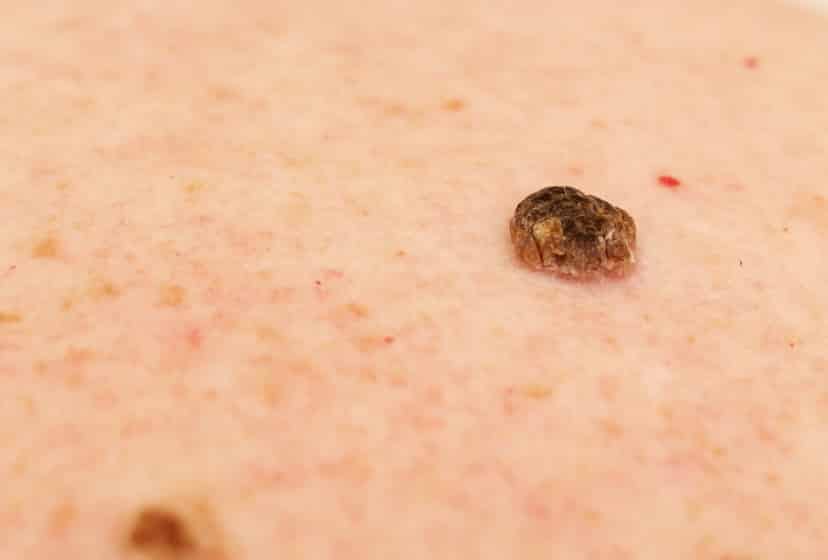 verrue seborrheique ou melanome 3