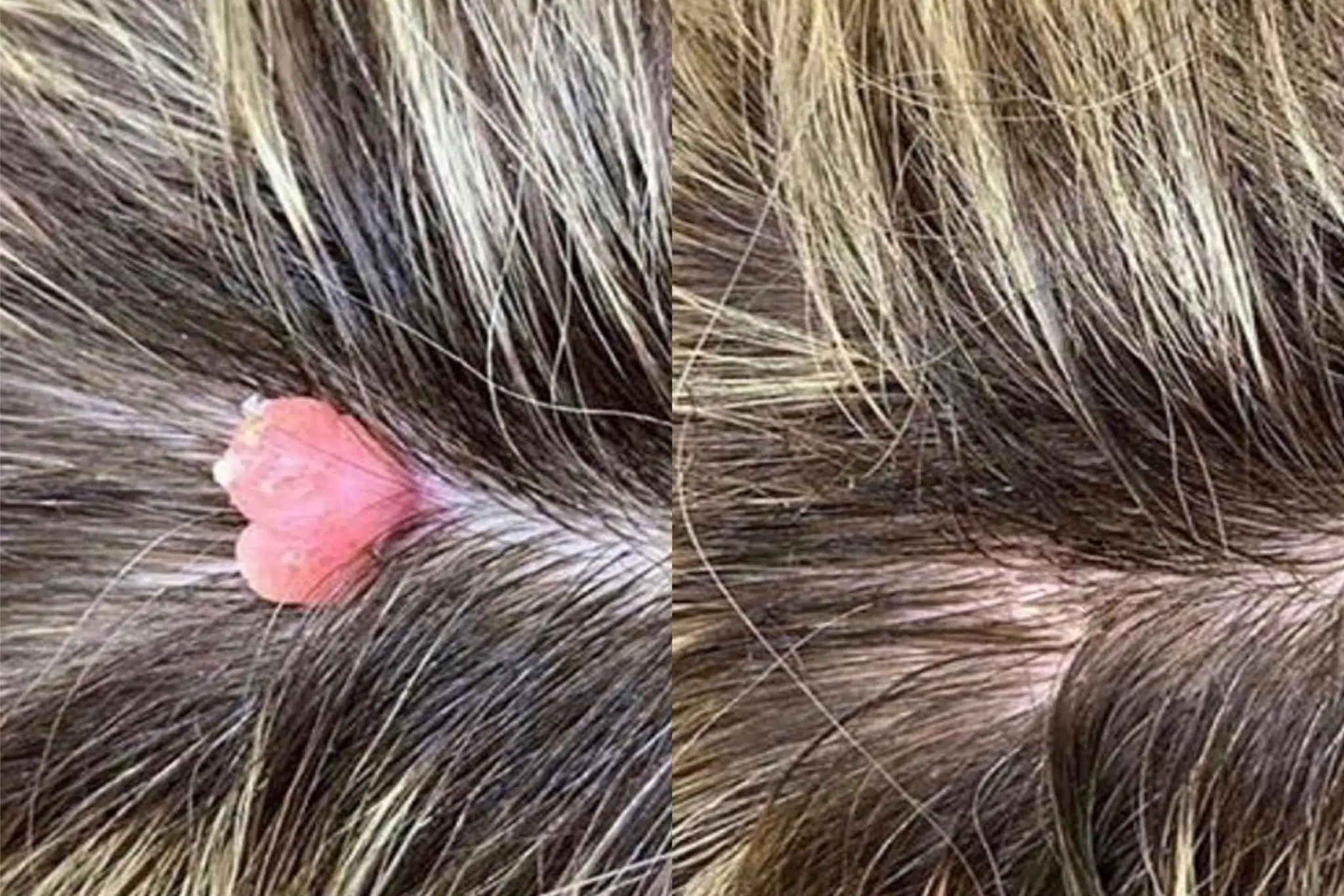 naevus cuir chevelu avant apres