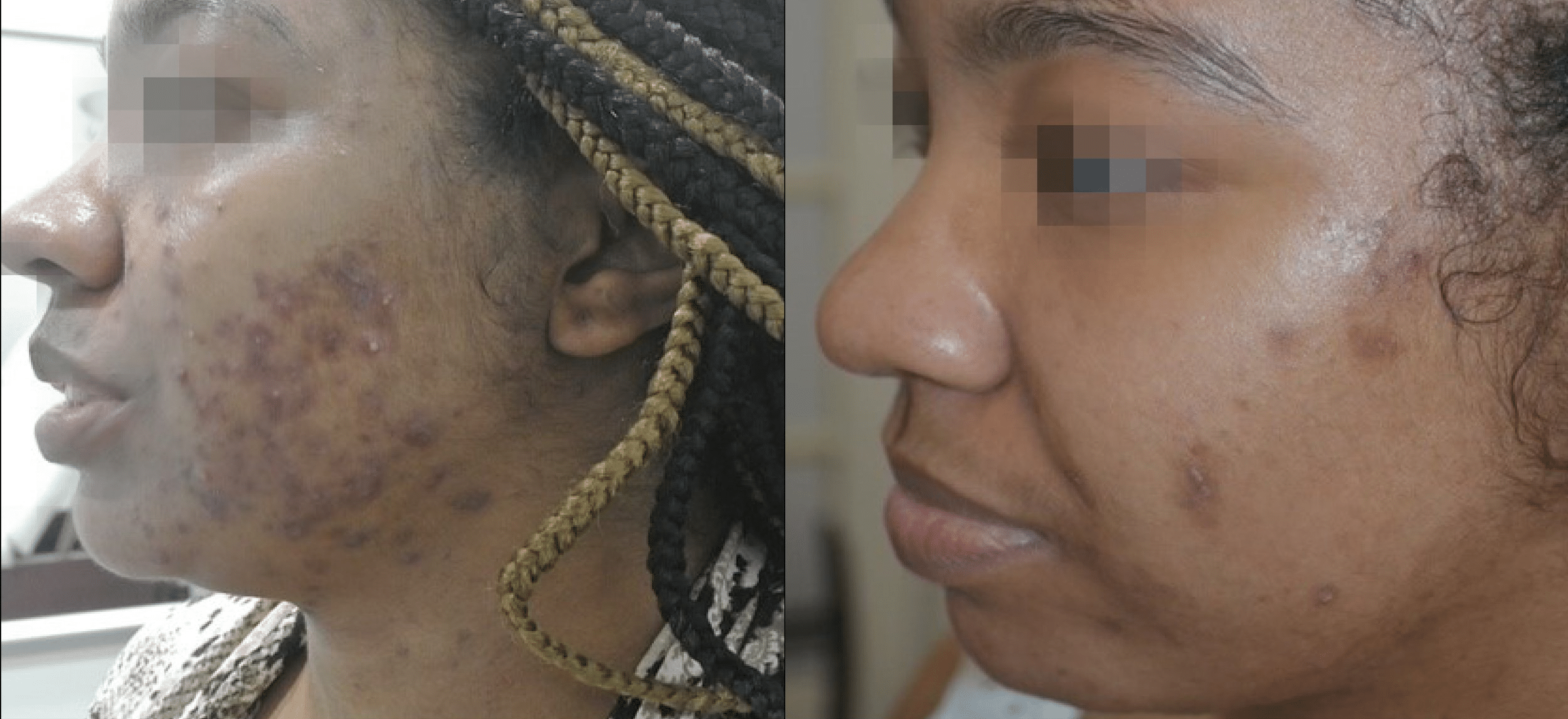 hyperpigmentation post inflammatoire traitement picosure pro