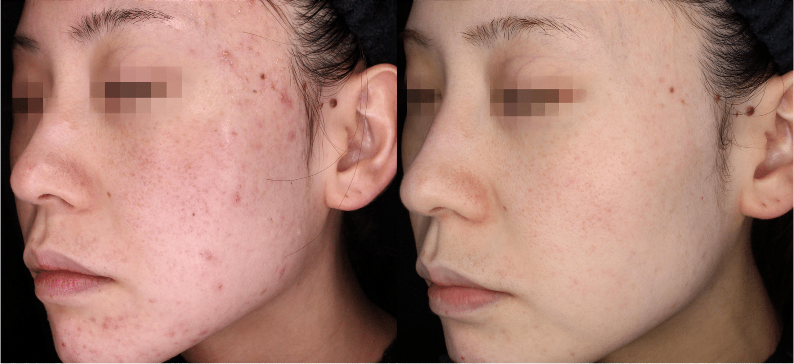 hyperpigmentation post inflammatoire traitement picosure pro