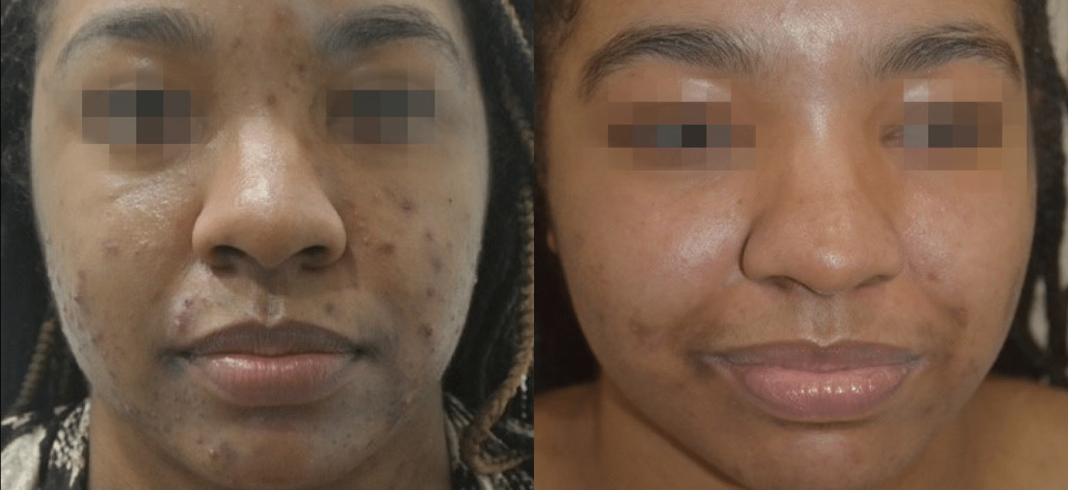 hyperpigmentation post inflammatoire traitement picosure pro