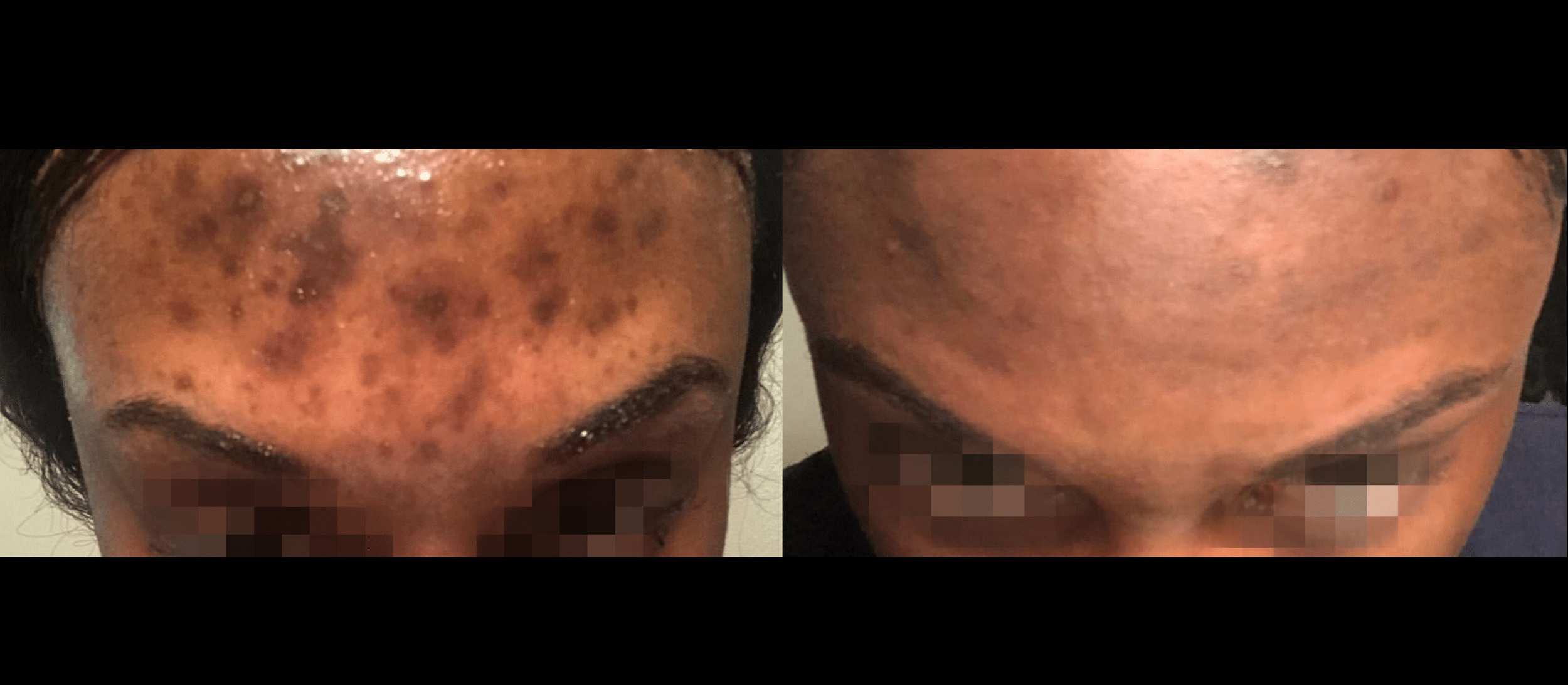 hyperpigmentation post inflammatoire traitement picosure pro