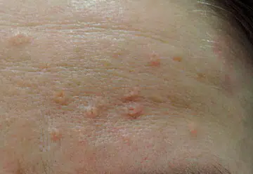 hyperplasie sebacée photo traitement laser paris